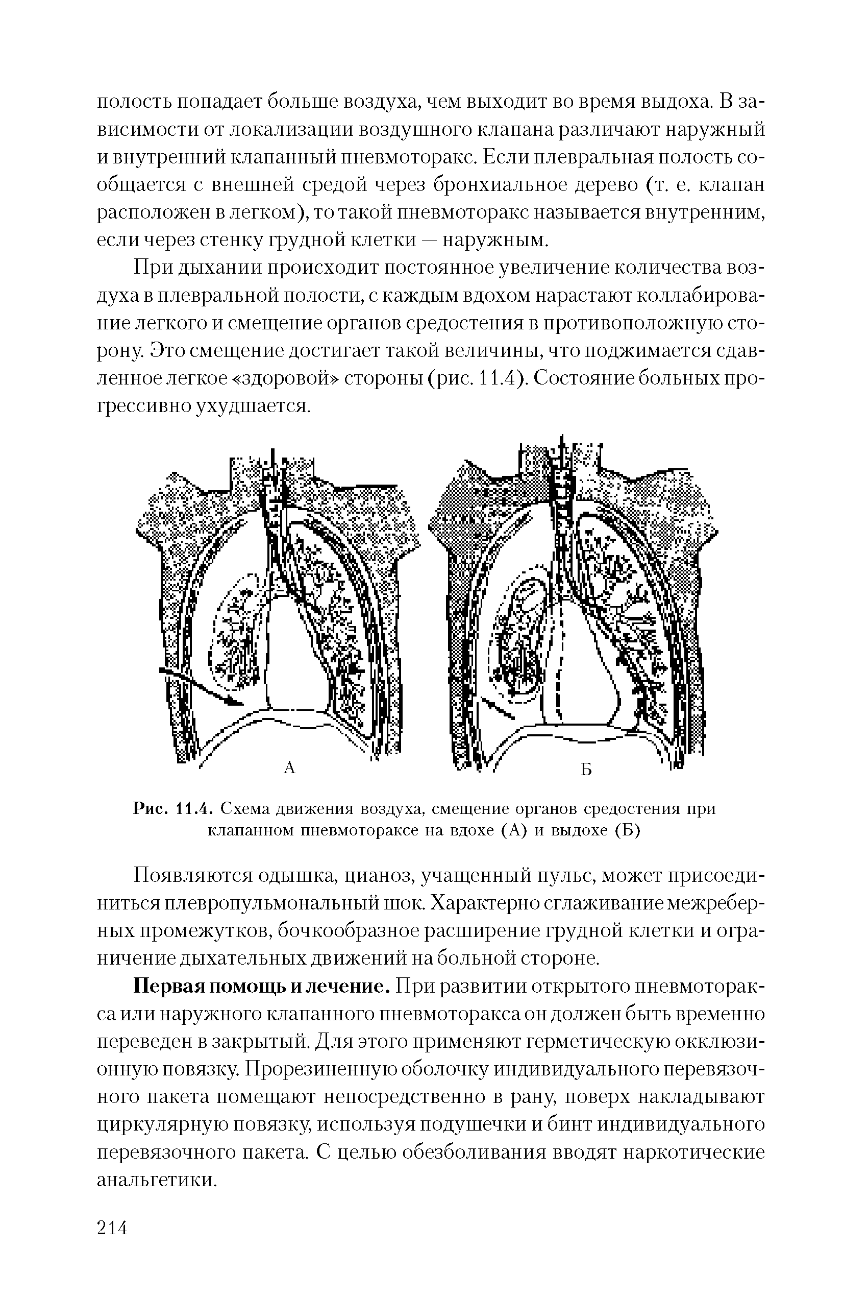 Рис. 11.4. Схема движения воздуха, смещение органов средостения при клапанном пневмотораксе на вдохе (А) и выдохе (Б)...