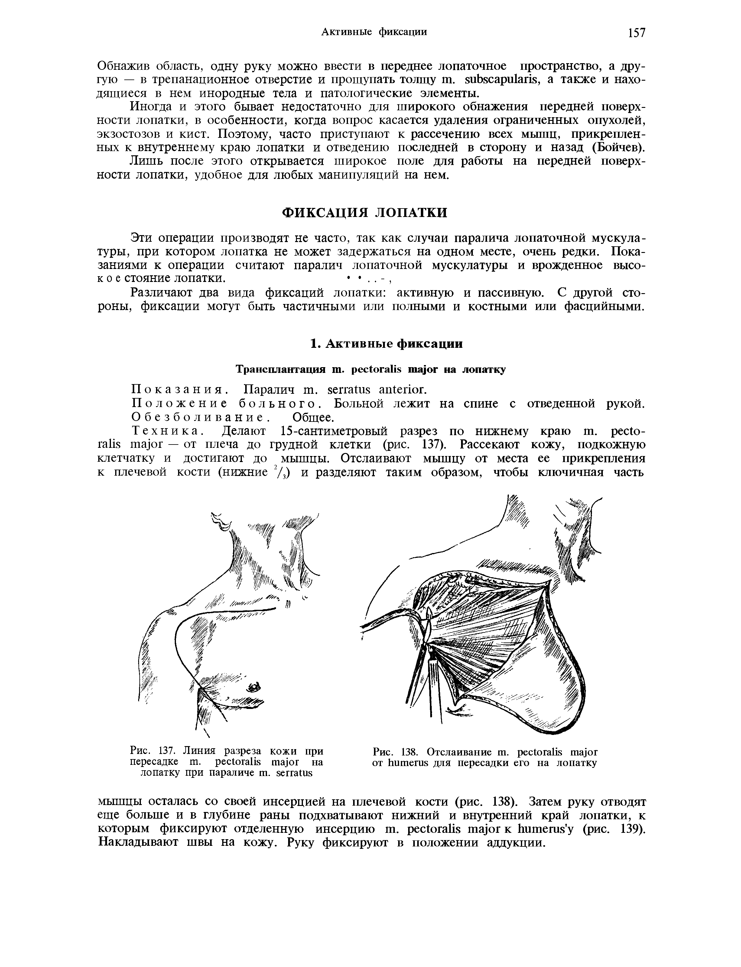 Рис. 137. Линия разреза кожи при пересадке . на лопатку при параличе . ...