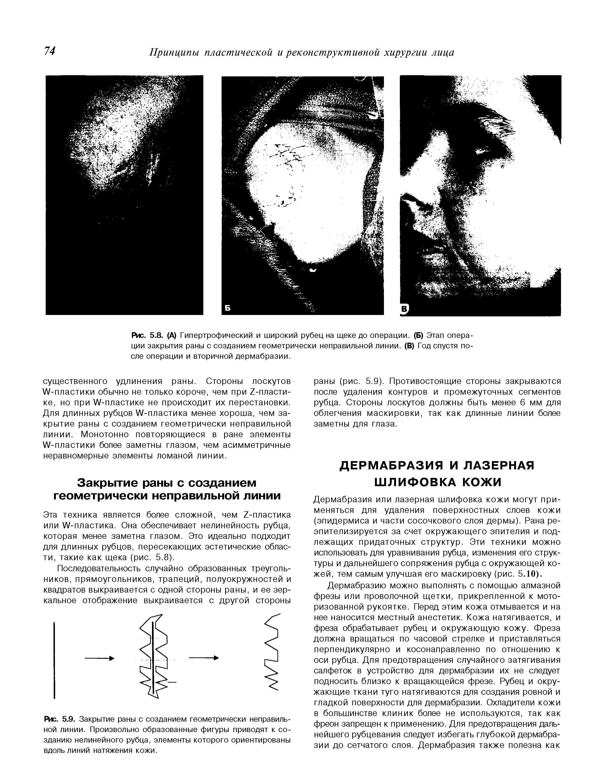 Рис. 5.8. (А) Гипертрофический и широкий рубец на щеке до операции. (Б) Этап операции закрытия раны с созданием геометрически неправильной линии. (В) Год спустя после операции и вторичной дермабразии.