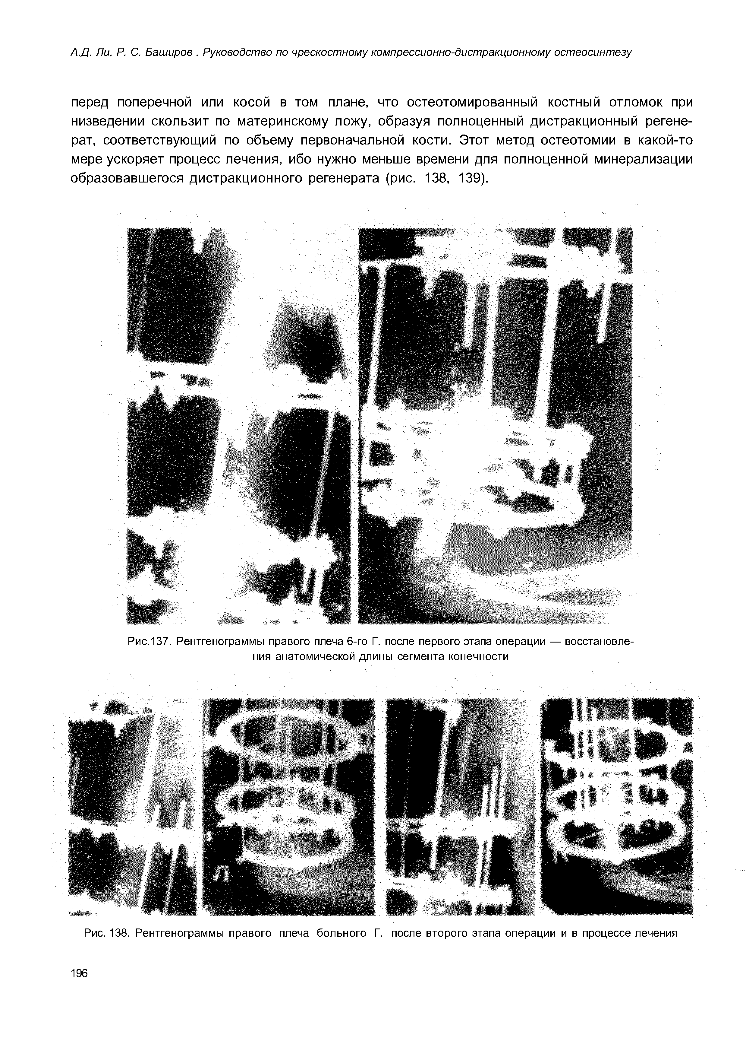 Рис. 137. Рентгенограммы правого плеча 6-го Г. после первого этапа операции — восстановления анатомической длины сегмента конечности...