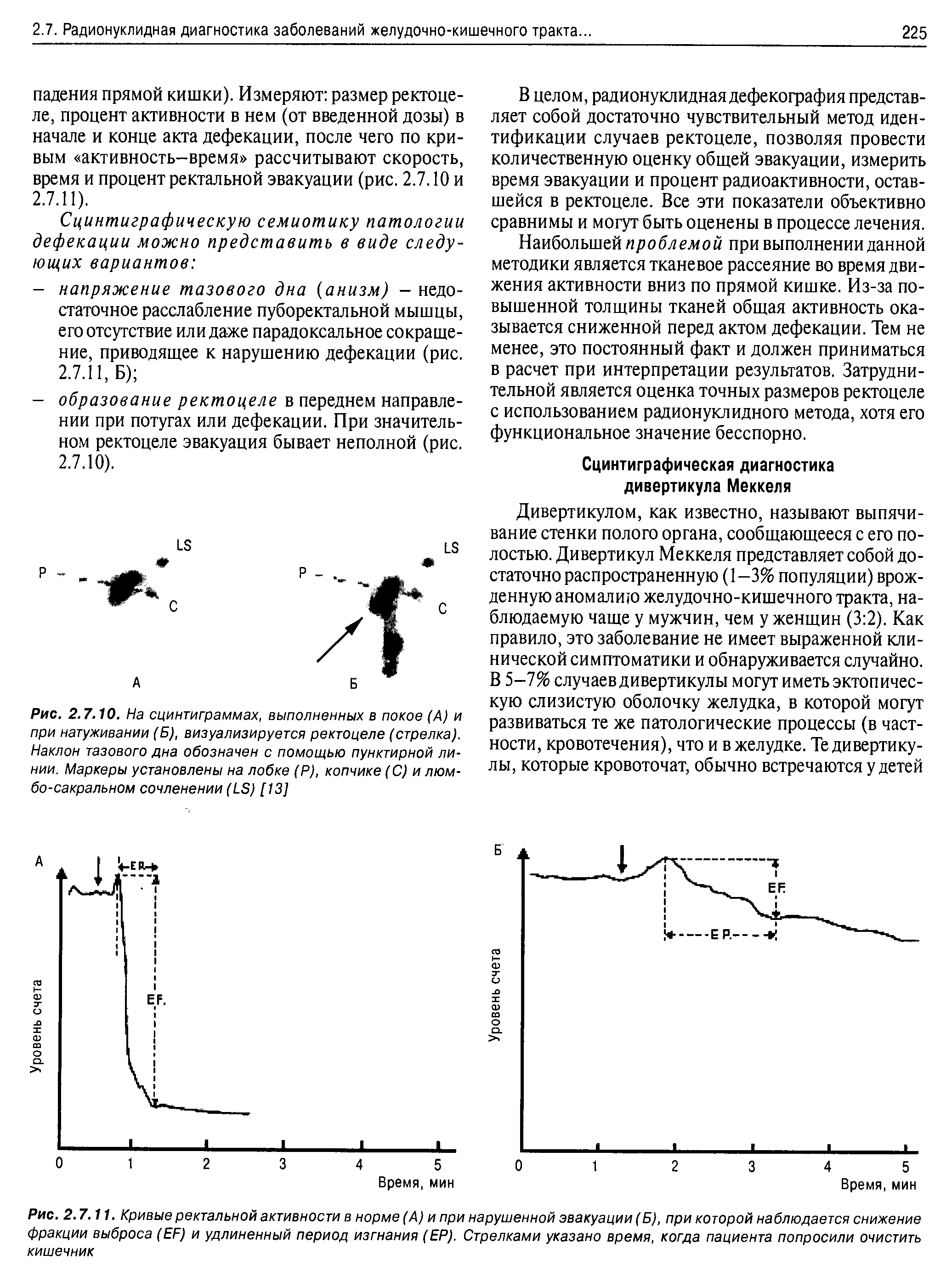 Рис. 2.7.11. Кривые ректальной активности в норме (А) и при нарушенной эвакуации (Б), при которой наблюдается снижение фракции выброса (ЕБ) и удлиненный период изгнания (ЕР). Стрелками указано время, когда пациента попросили очистить кишечник...