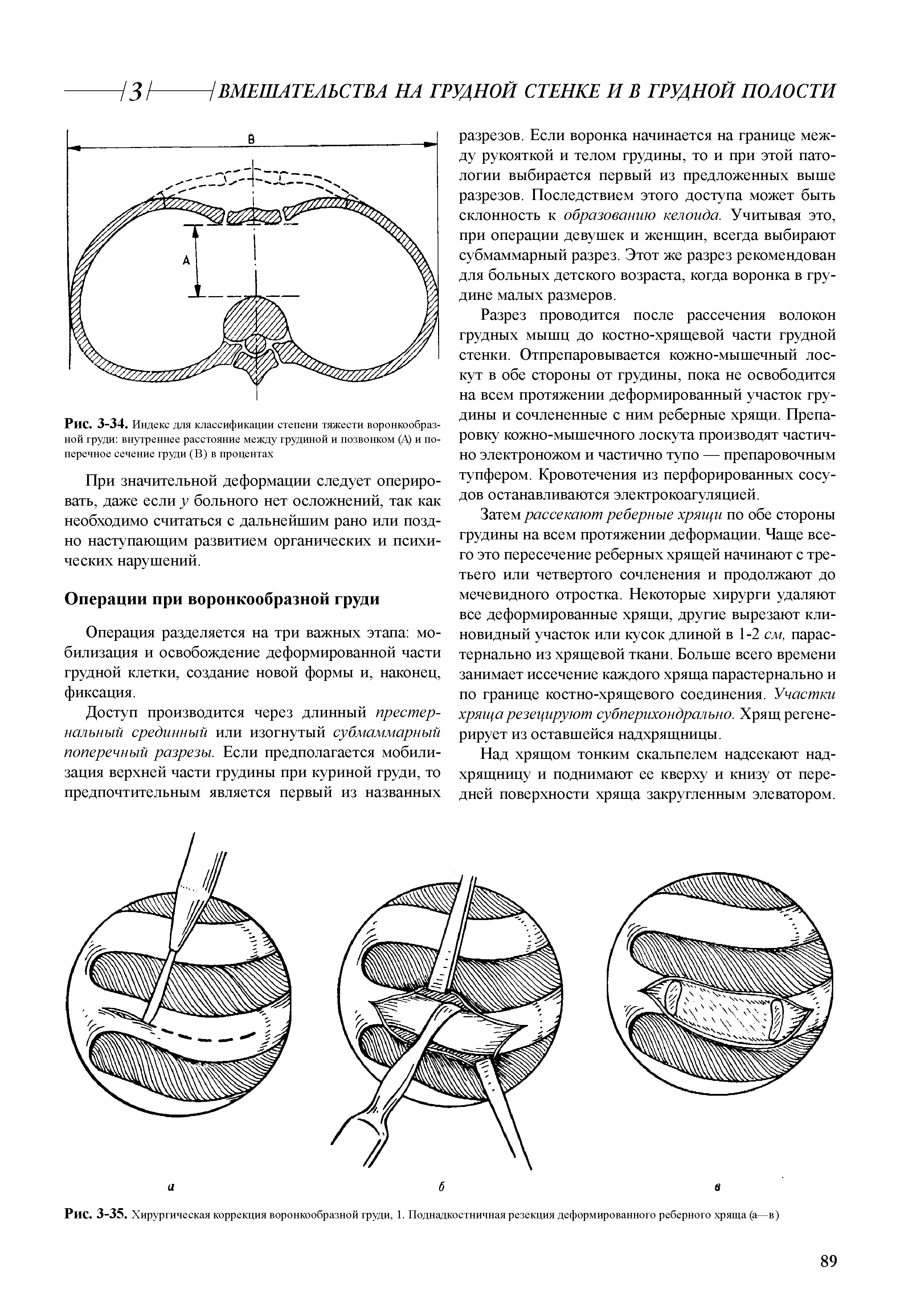 Рис. 3-34. Индекс для классификации степени тяжести воронкообразной груди внутреннее расстояние между грудиной и позвонком (А) и поперечное сечение груди (В) в процентах...