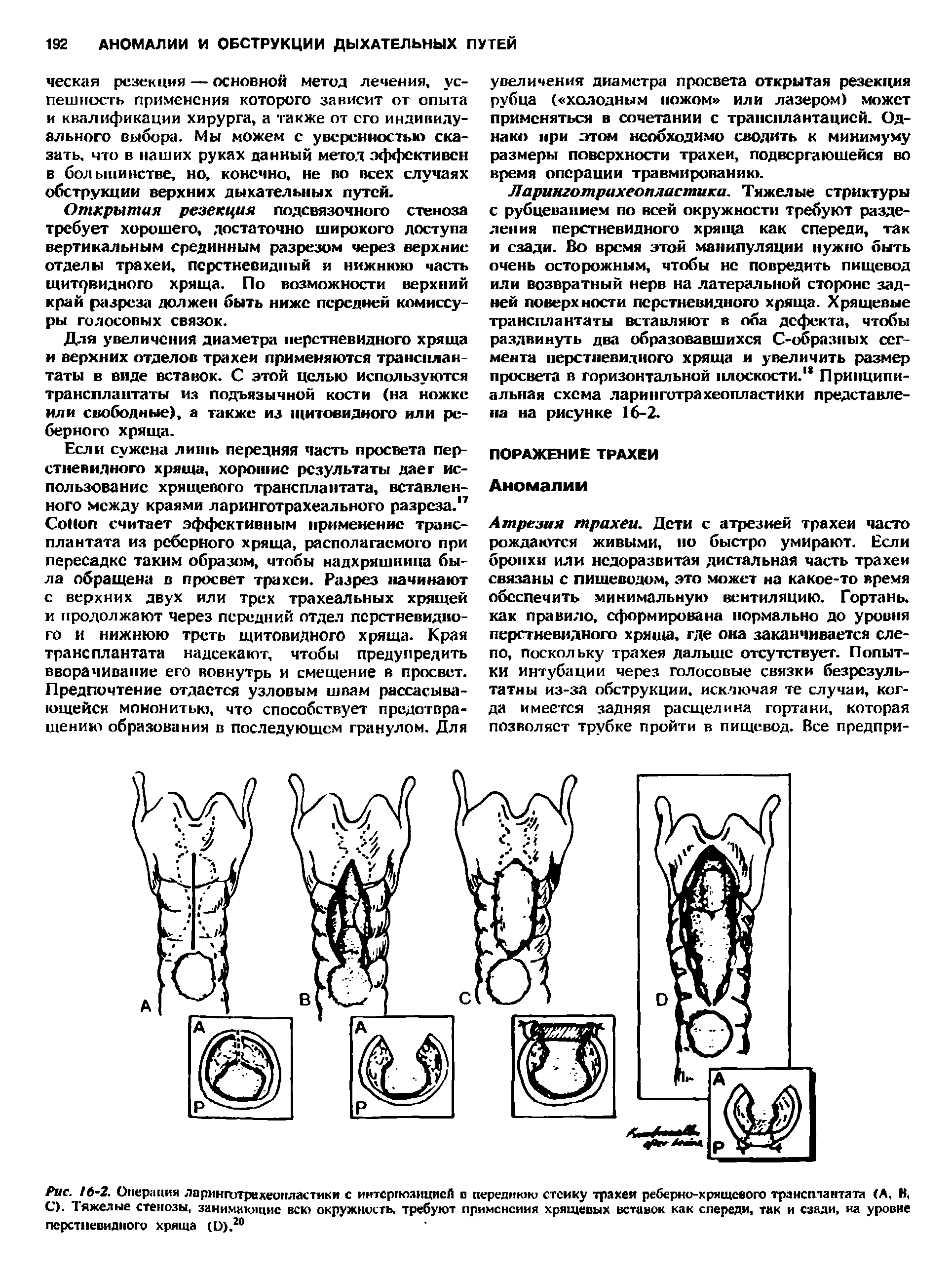 Рис. 16-2. Операция ларинготрехеопластики с интерпоаицией и переднюю стейку трахеи реберно-хрящевого трансплантата (А, В, С). Тяжелые стенозы, занимающие всю окружность, требуют применения хрящевых вставок как спереди, так и сзади, на уровне перстневидного хряща (О).20...