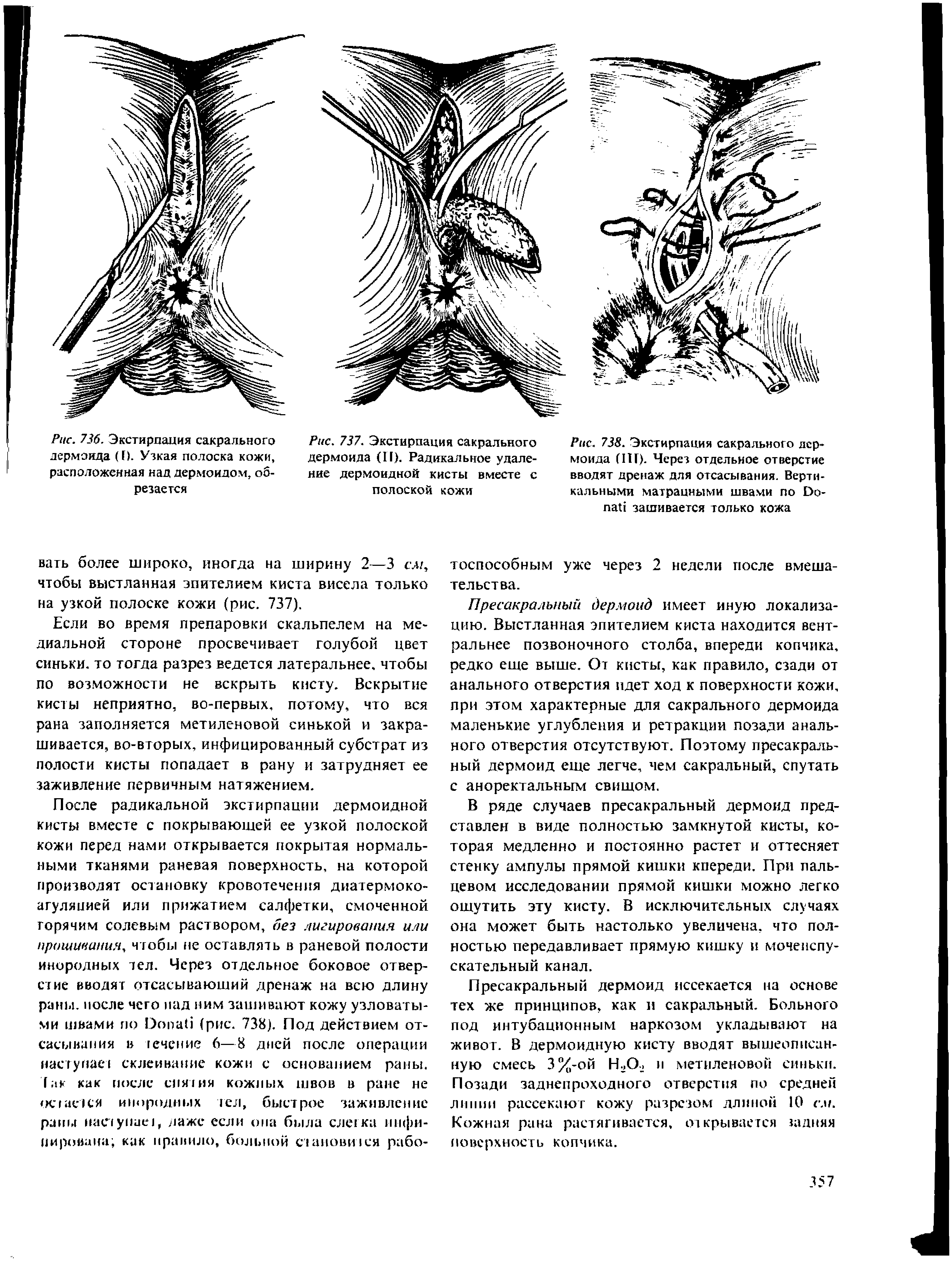 Рис. 738. Экстирпация сакрального дермоида (ПГ). Через отдельное отверстие вводят дренаж для отсасывания. Вертикальными матрацными швами по Оо-пай зашивается только кожа...