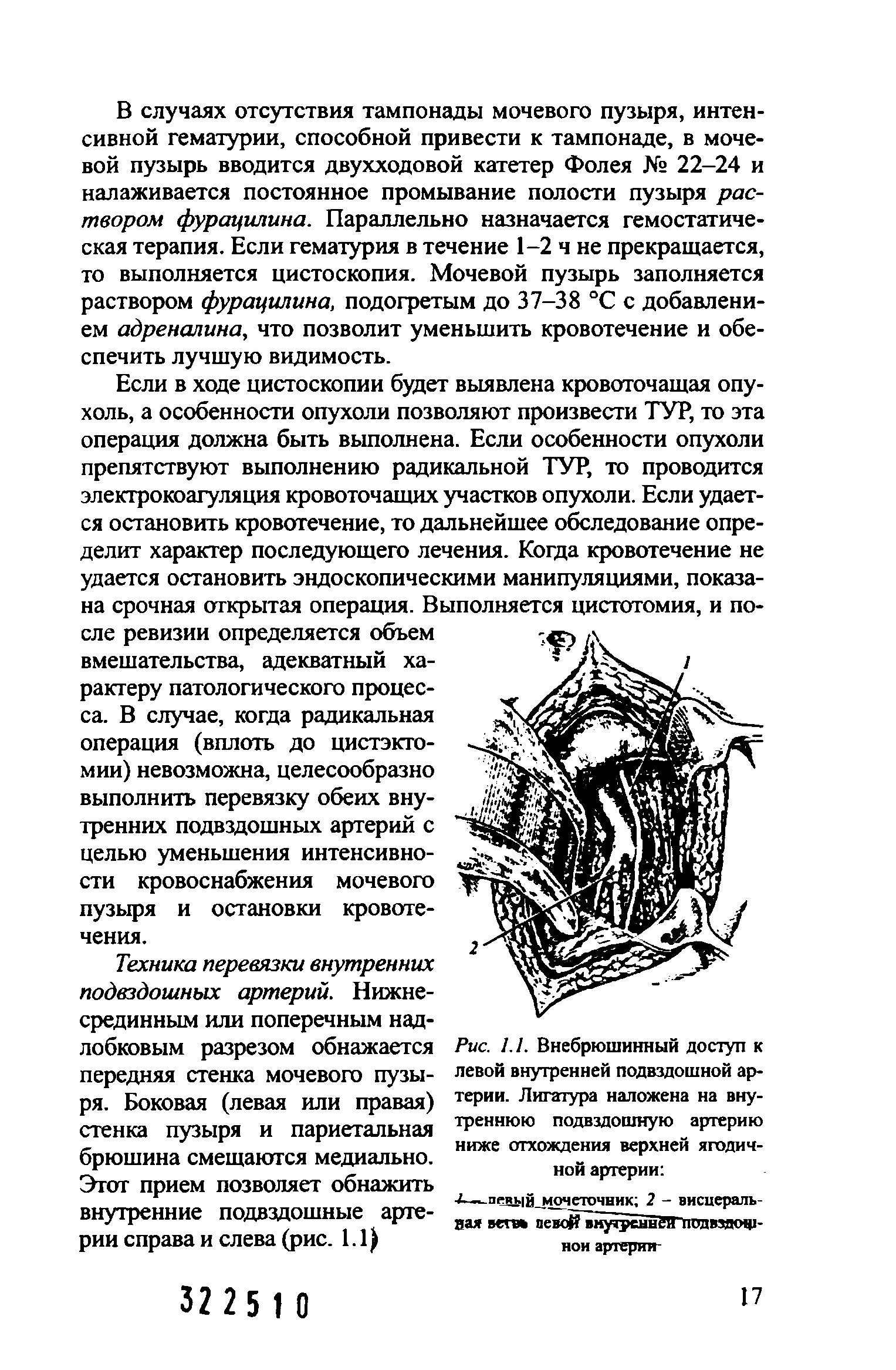 Рис. 1.1. Внебрюшинный доступ к левой внутренней подвздошной артерии. Лигатура наложена на внутреннюю подвздошную артерию ниже отхождения верхней ягодичной артерии ...