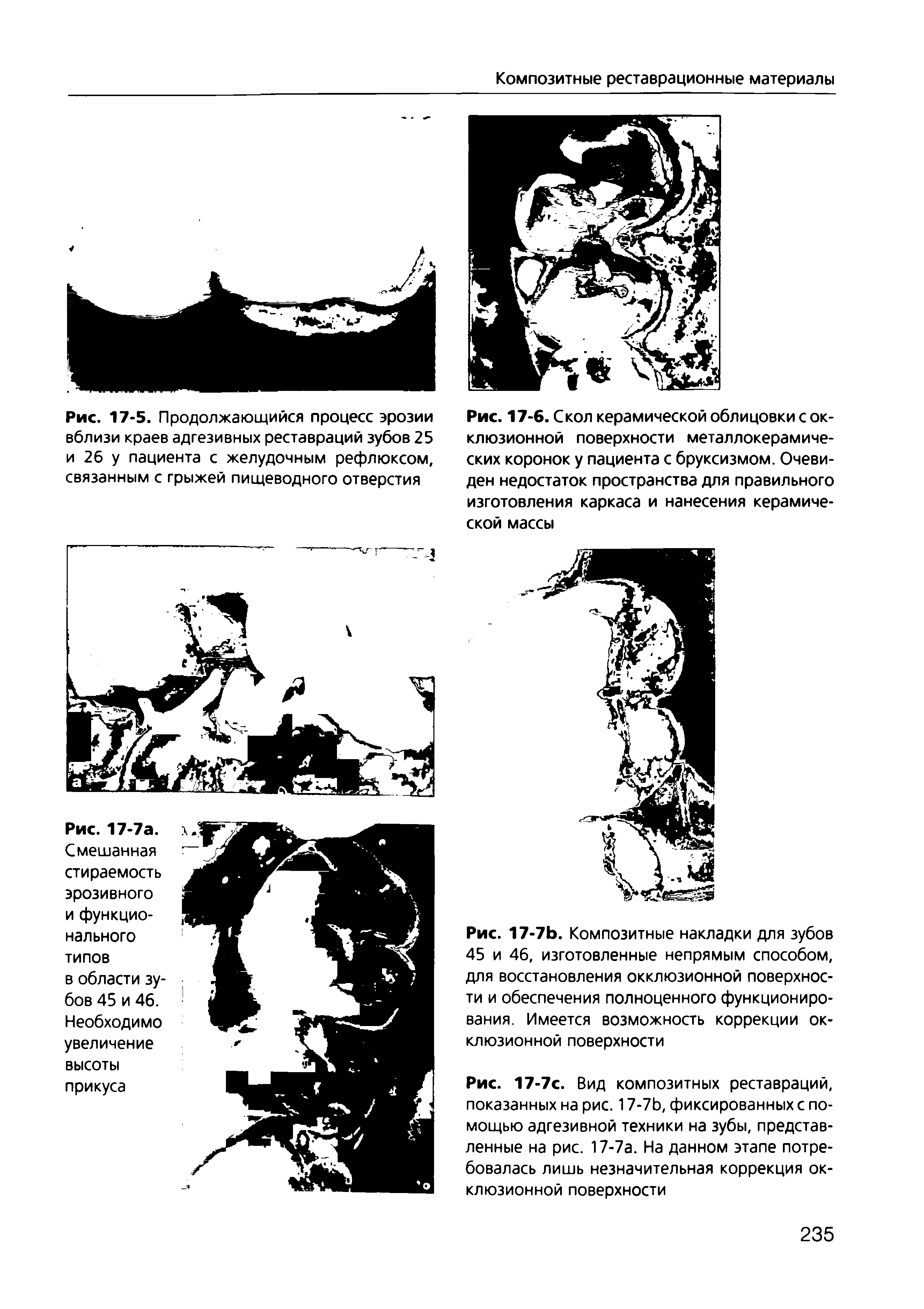 Рис. 17-7с. Вид композитных реставраций, показанных на рис. 17-7Ь, фиксированных с помощью адгезивной техники на зубы, представленные на рис. 17-7а. На данном этапе потребовалась лишь незначительная коррекция окклюзионной поверхности...