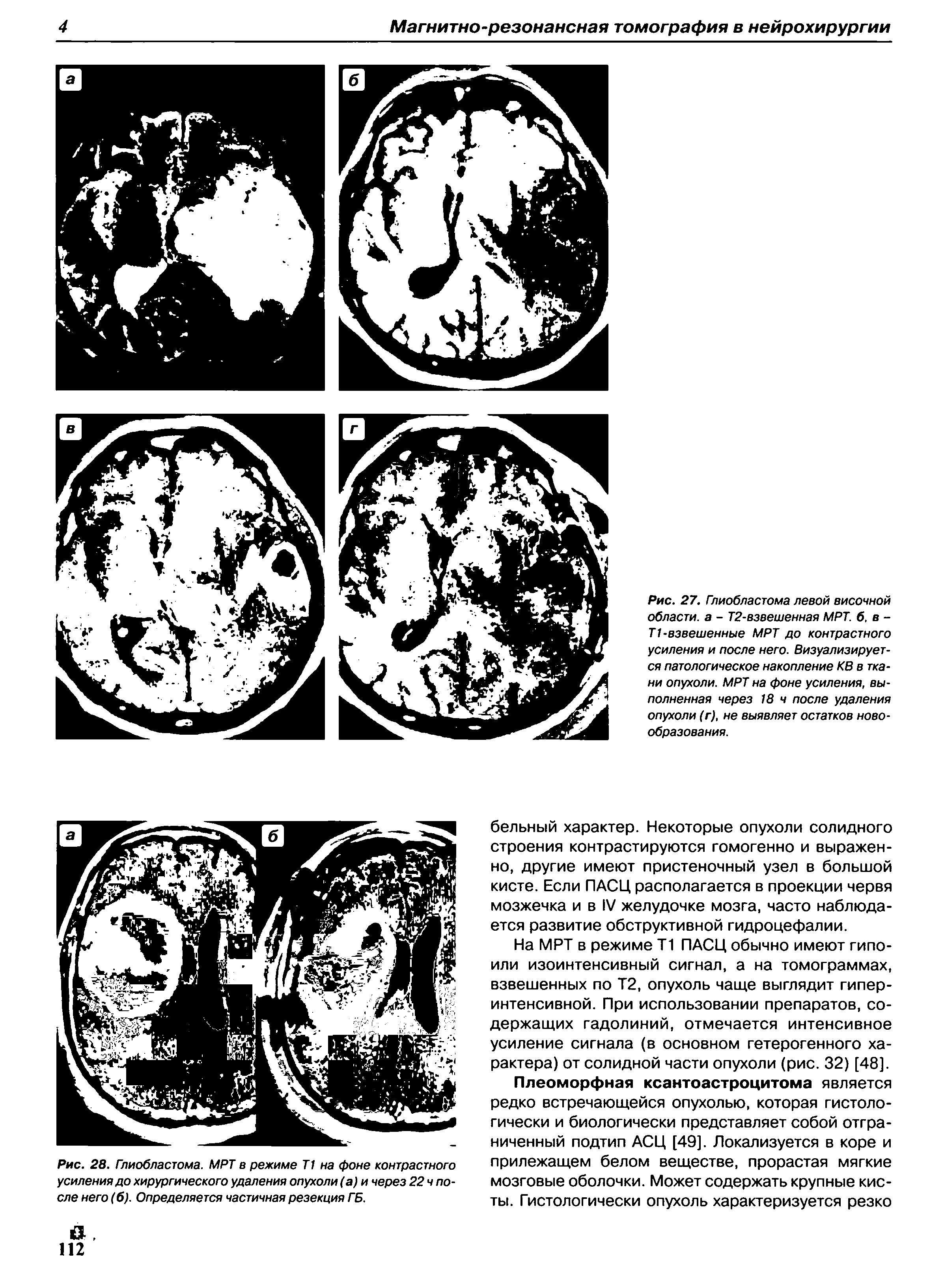 Рис. 28. Глиобластома. МРТ в режиме Т1 на фоне контрастного усиления до хирургического удаления опухоли (а) и через 22чпо-сле него (6). Определяется частичная резекция ГБ.