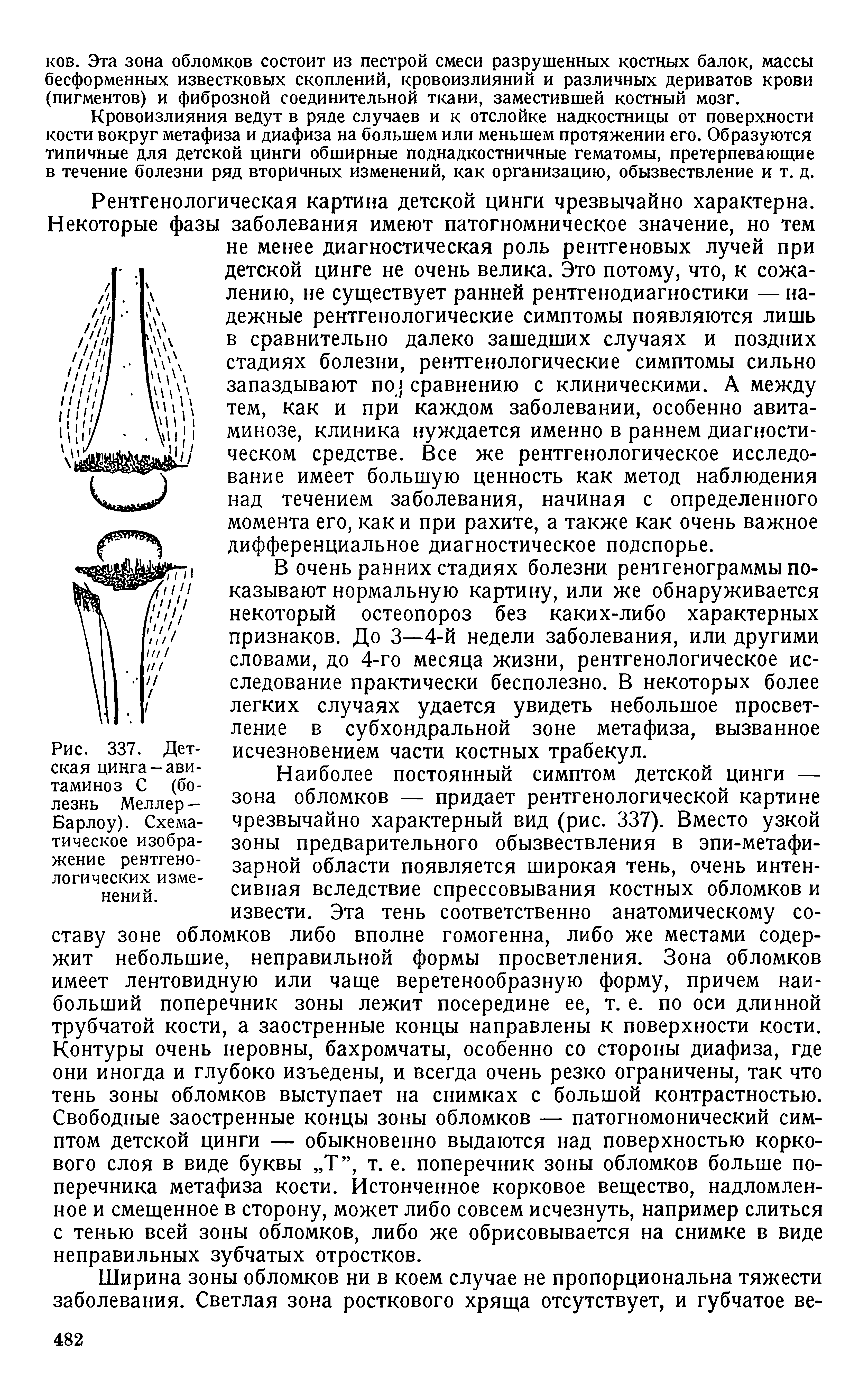 Рис. 337. Детская цинга-авитаминоз С (болезнь Меллер — Барлоу). Схематическое изображение рентгенологических изменений.