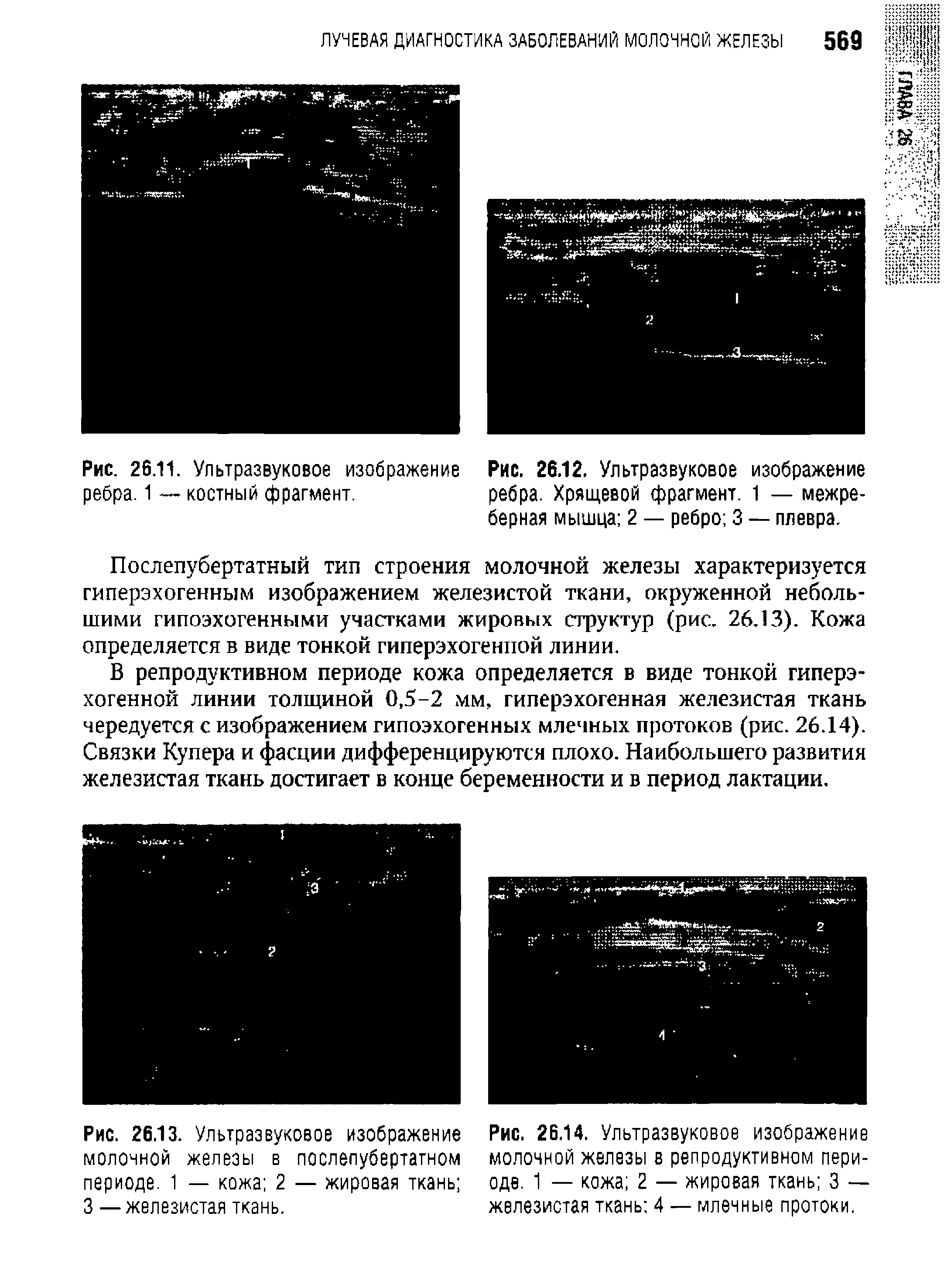 Рис. 26.12. Ультразвуковое изображение ребра. Хрящевой фрагмент. 1 — межреберная мышца 2 — ребро 3 — плевра.