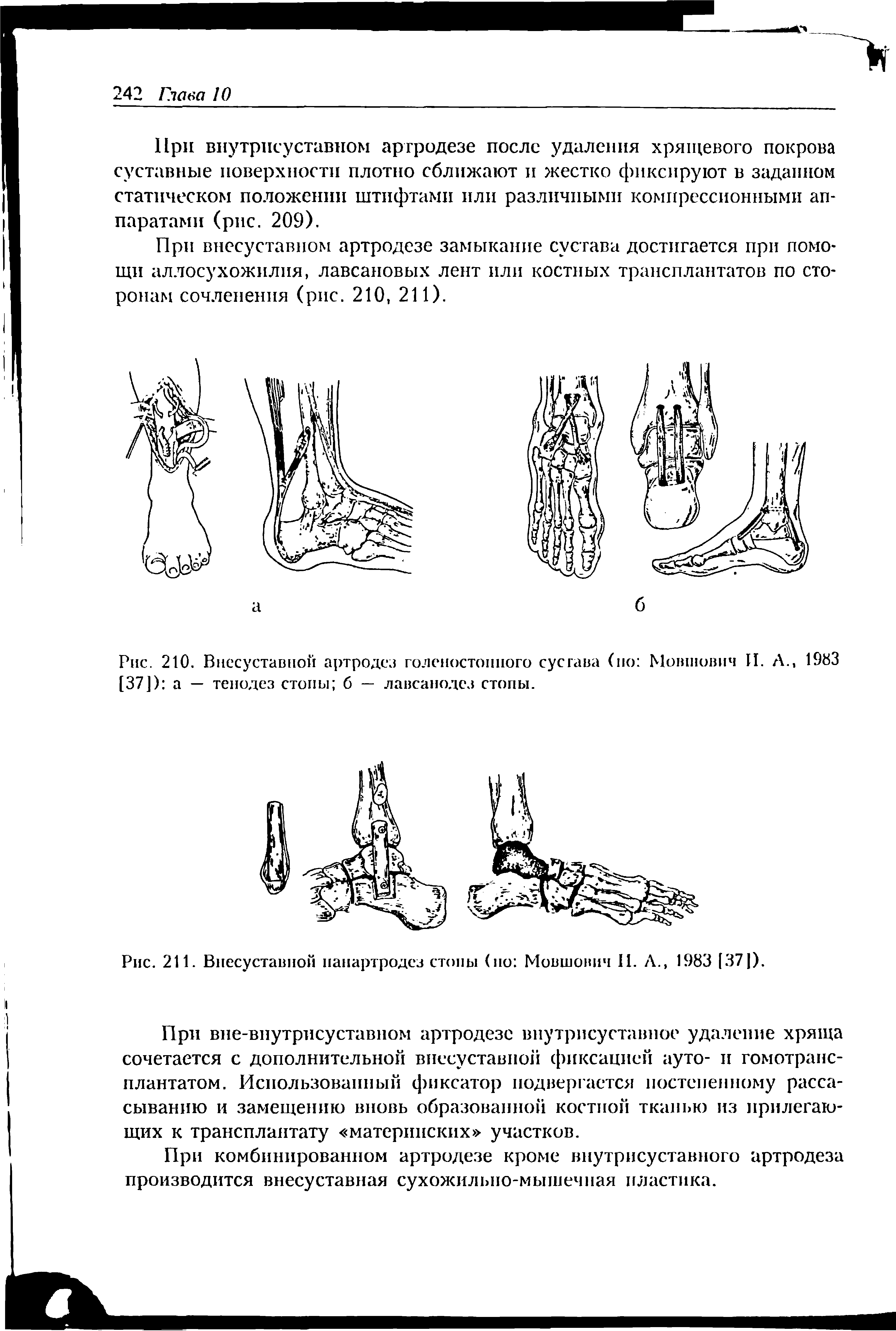 Рис. 210. Внесуставной артродез голеностопного сустава (по Мовтович II. А., 1983 [37]) а — тенодез стопы б — лавсанодез стопы.