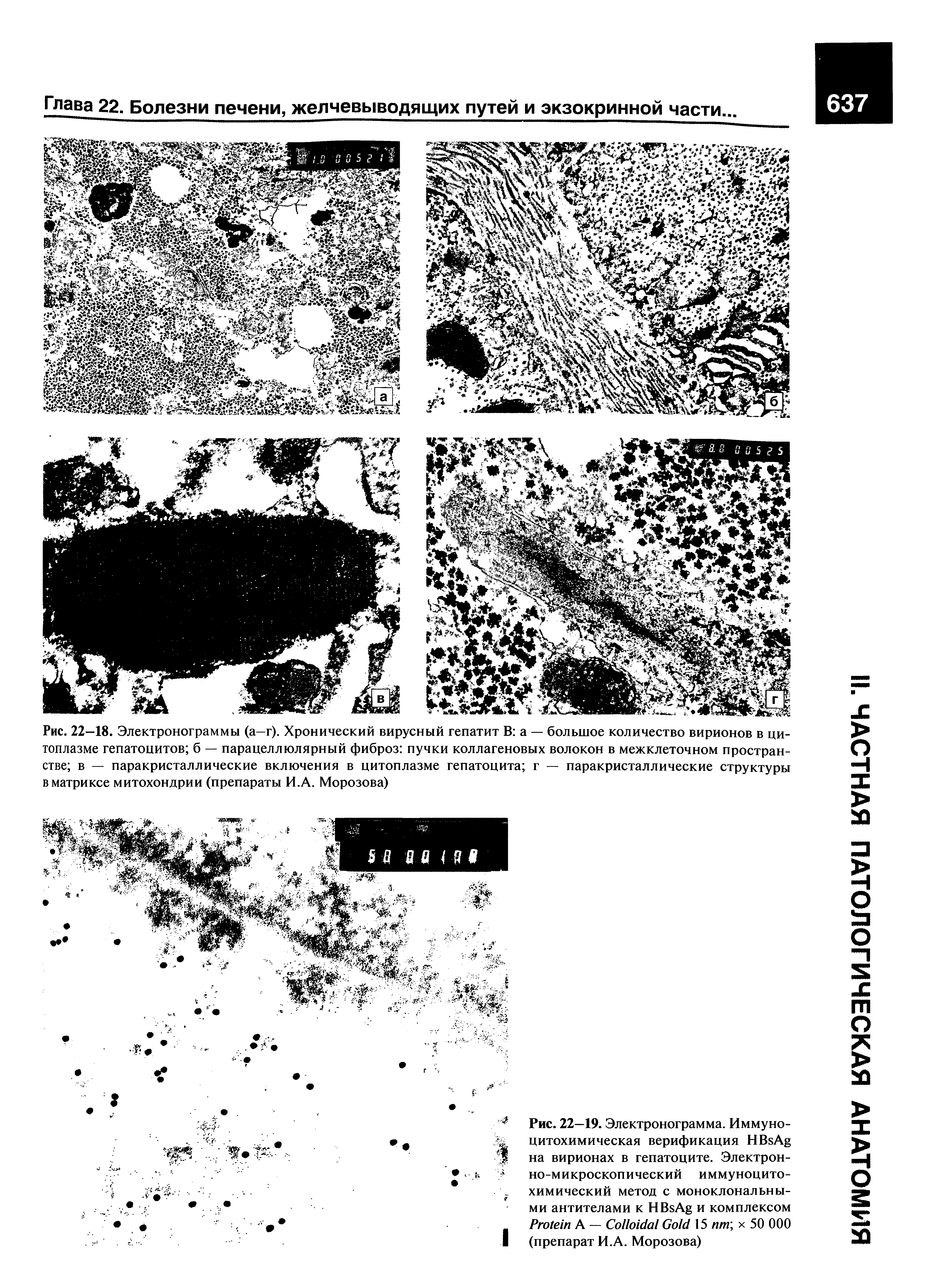 Рис. 22—19. Электронограмма. Иммуноцитохимическая верификация HB A на вирионах в гепатоците. Электронно-микроскопический иммуноцитохимический метод с моноклональными антителами к HB A и комплексом P А — C G 15 пт х 50 000 (препарат И.А. Морозова)...