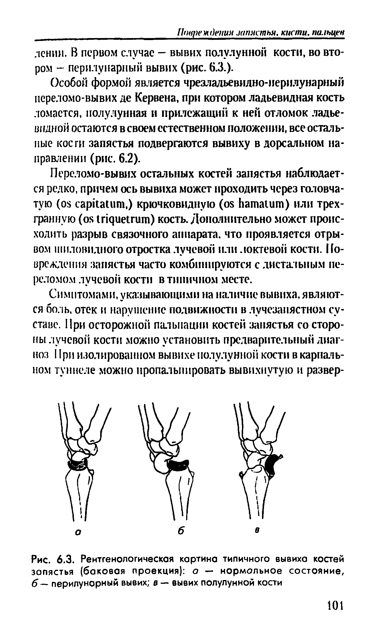 Рис. 6.3. Рентгенологическая картина типичного вывиха костей запястья (баковая проекция) а — нормальное состояние, 5— перилунарный вывих в — вывих полулунной кости...