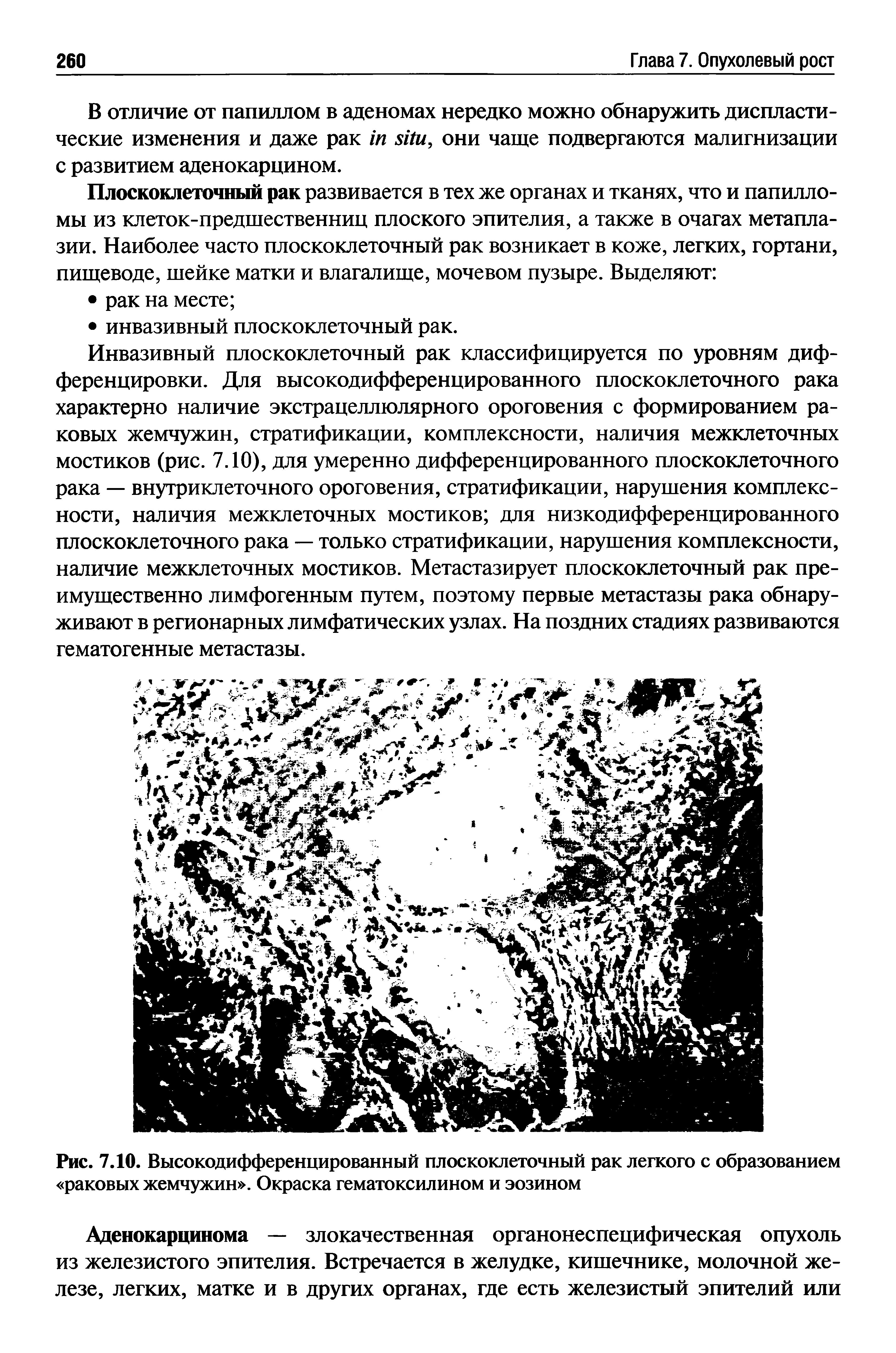 Рис. 7.10. Высокодифференцированный плоскоклеточный рак легкого с образованием раковых жемчужин . Окраска гематоксилином и эозином...