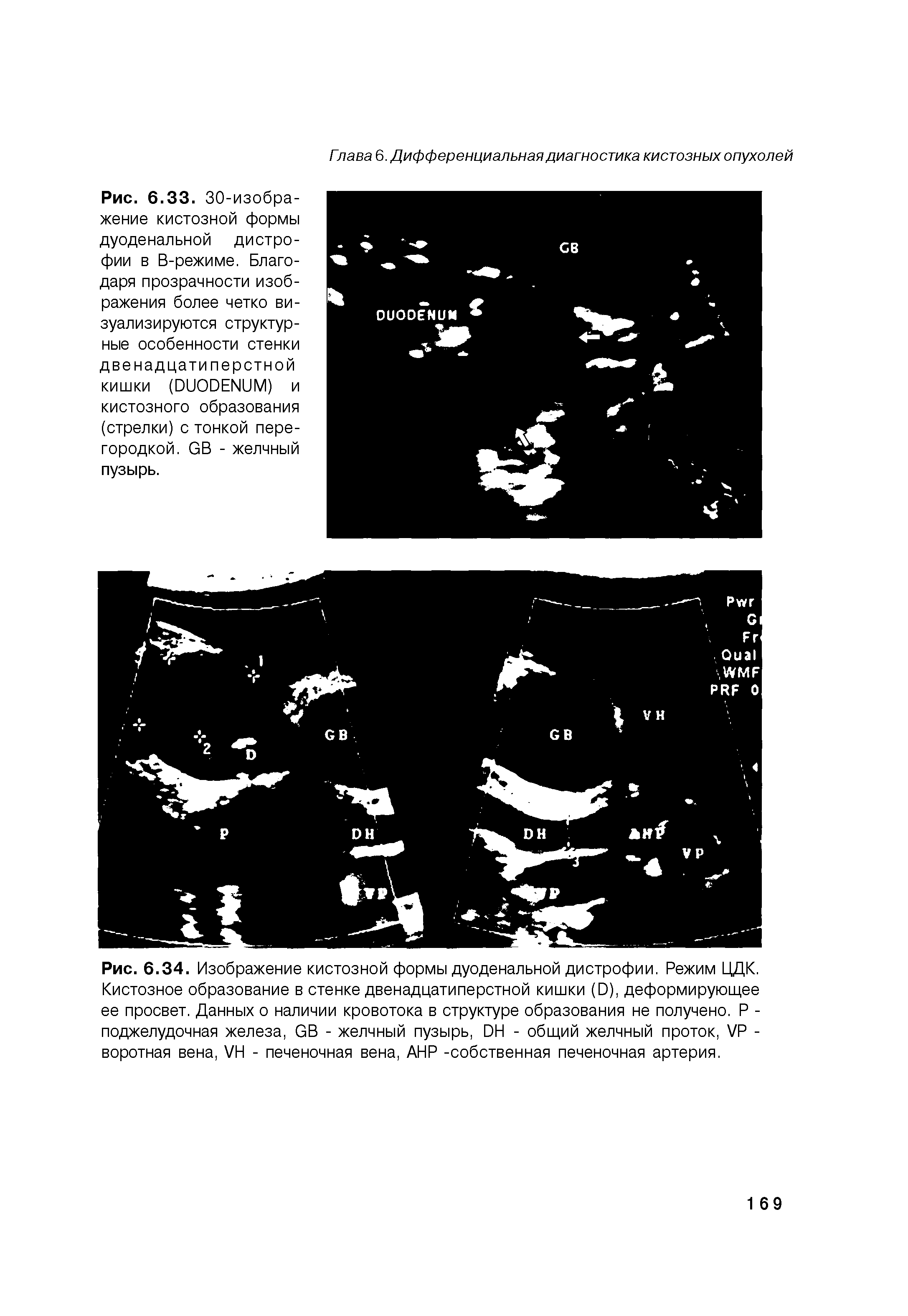 Рис. 6.34. Изображение кистозной формы дуоденальной дистрофии. Режим ЦДК. Кистозное образование в стенке двенадцатиперстной кишки (0), деформирующее ее просвет. Данных о наличии кровотока в структуре образования не получено. Р -поджелудочная железа, вВ - желчный пузырь, ОН - общий желчный проток, Х/Р -воротная вена, УН - печеночная вена, АНР -собственная печеночная артерия.