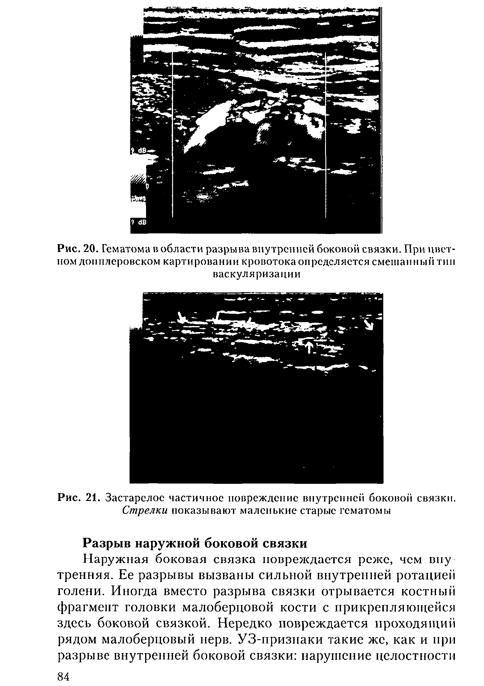 Рис. 21. Застарелое частичное повреждение внутренней боковой связки. Стрелки показывают маленькие старые гематомы...