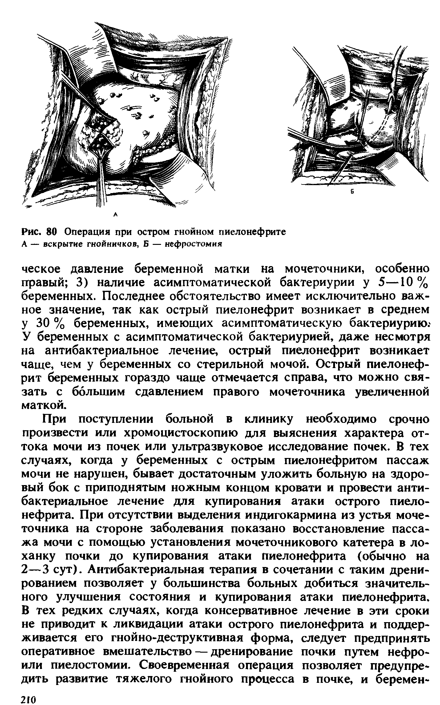 Рис. 80 Операция при остром гнойном пиелонефрите А — вскрытие гнойничков, Б — нефростомия...