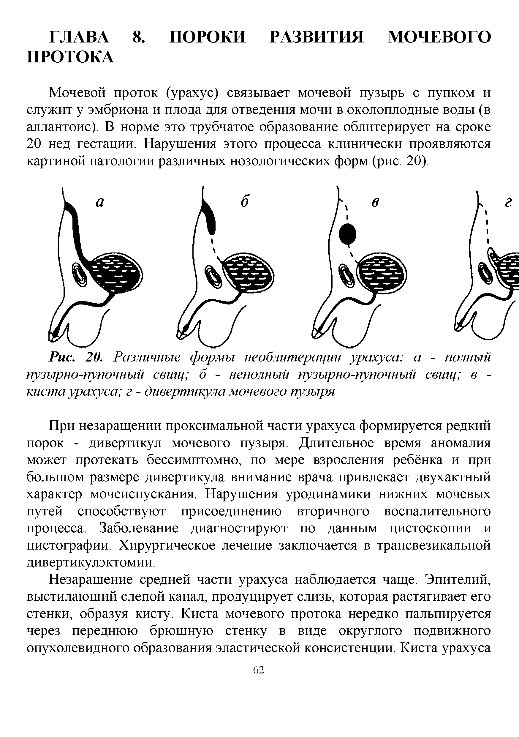 Рис. 20. Различные формы необлитерации урахуса а - полный пузырно-пупочный свищ б - неполный пузырно-пупочный свищ в -киста урахуса г - дивертикула мочевого пузыря...