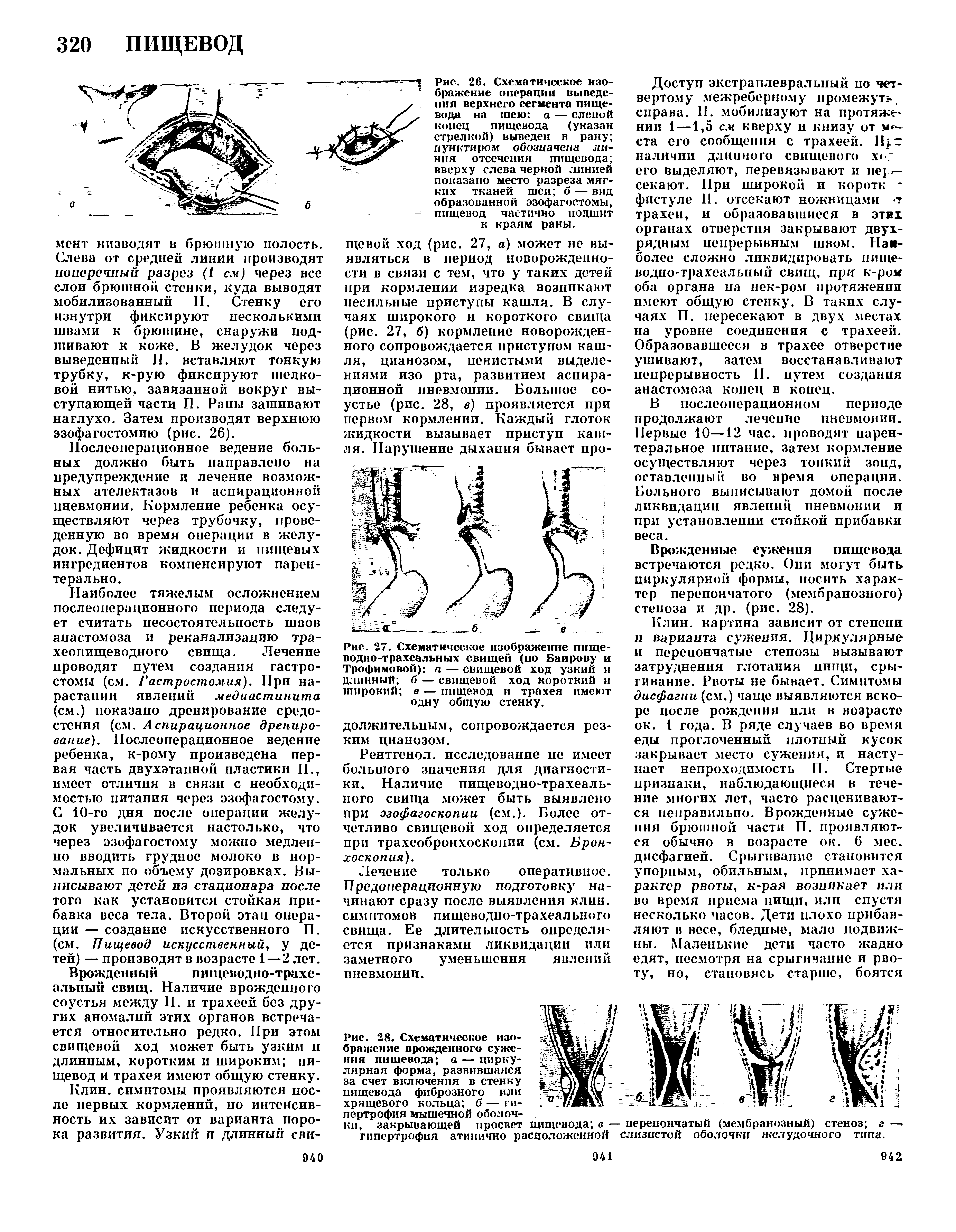 Рис. 28. Схематическое изображение врожденного сужения пищевода а — циркулярная форма, развившаяся за счет включения в стенку пищевода фиброзного или хрящевого кольца б — гипертрофия мышечной оболочки, закрывающей просвет...