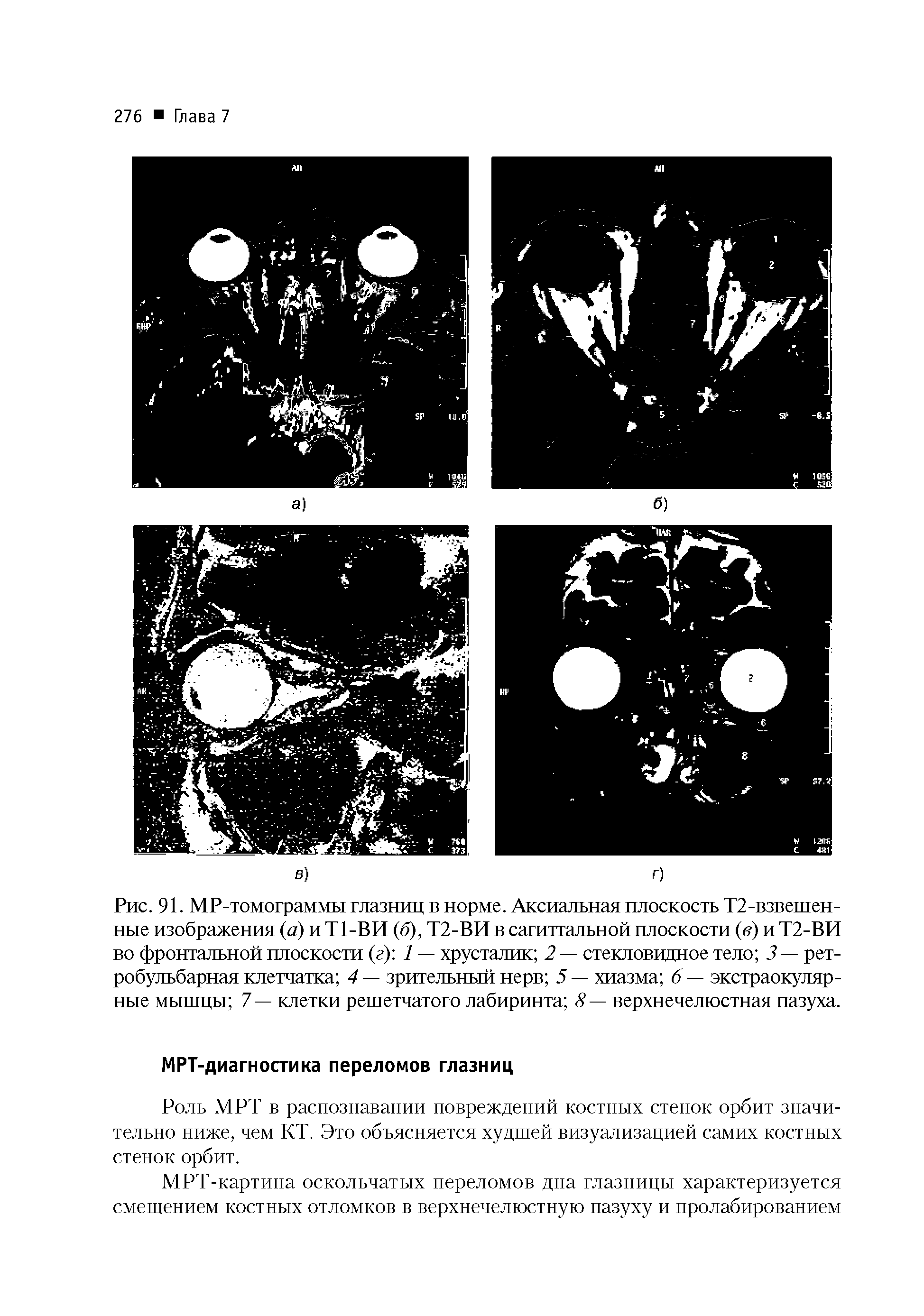 Рис. 91. МР-томограммы глазниц в норме. Аксиальная плоскость Т2-взвешенные изображения (а) и Т1-ВИ (б), Т2-ВИ в сагиттальной плоскости (в) и Т2-ВИ во фронтальной плоскости (г) / — хрусталик 2 — стекловидное тело 3 — ретробульбарная клетчатка 4 — зрительный нерв 5 — хиазма 6 — экстраокуляр-ные мышпы 7 — клетки решетчатого лабиринта 8 — верхнечелюстная пазуха.