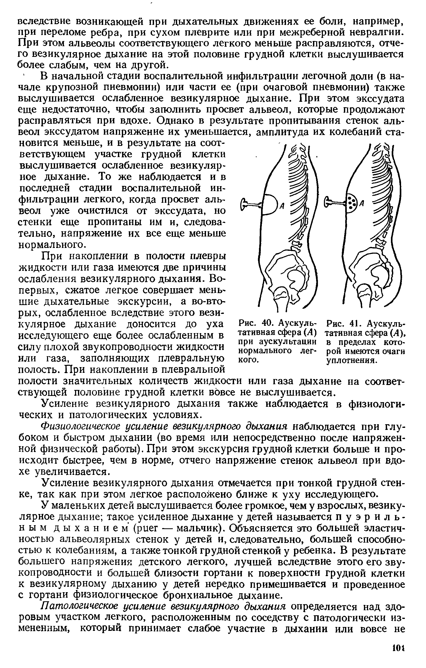 Рис. 41. Аускультативная сфера (А), в пределах которой имеются очаги уплотнения.