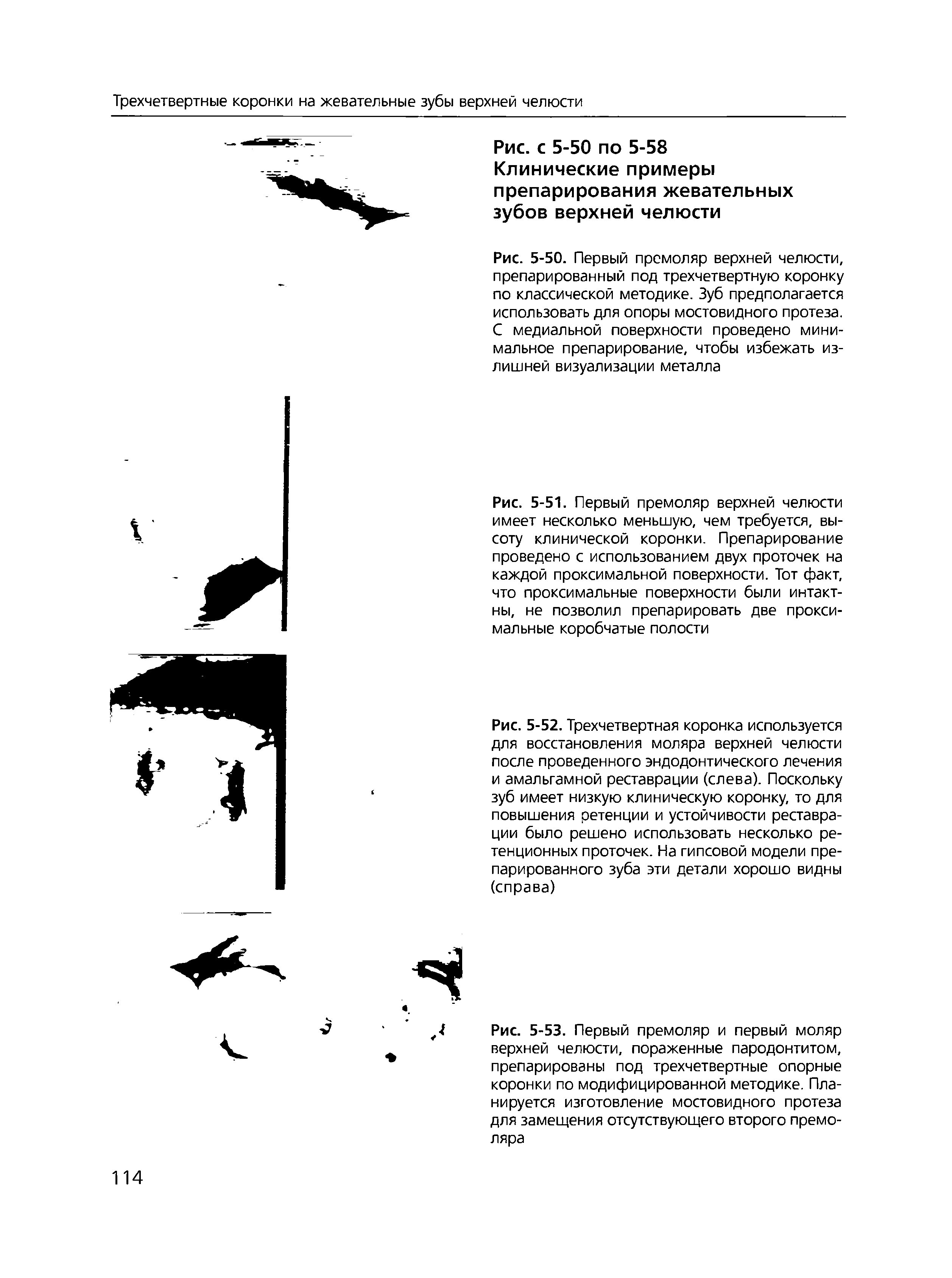 Рис. 5-50. Первый премоляр верхней челюсти, препарированный под трехчетвертную коронку по классической методике. Зуб предполагается использовать для опоры мостовидного протеза. С медиальной поверхности проведено минимальное препарирование, чтобы избежать излишней визуализации металла...