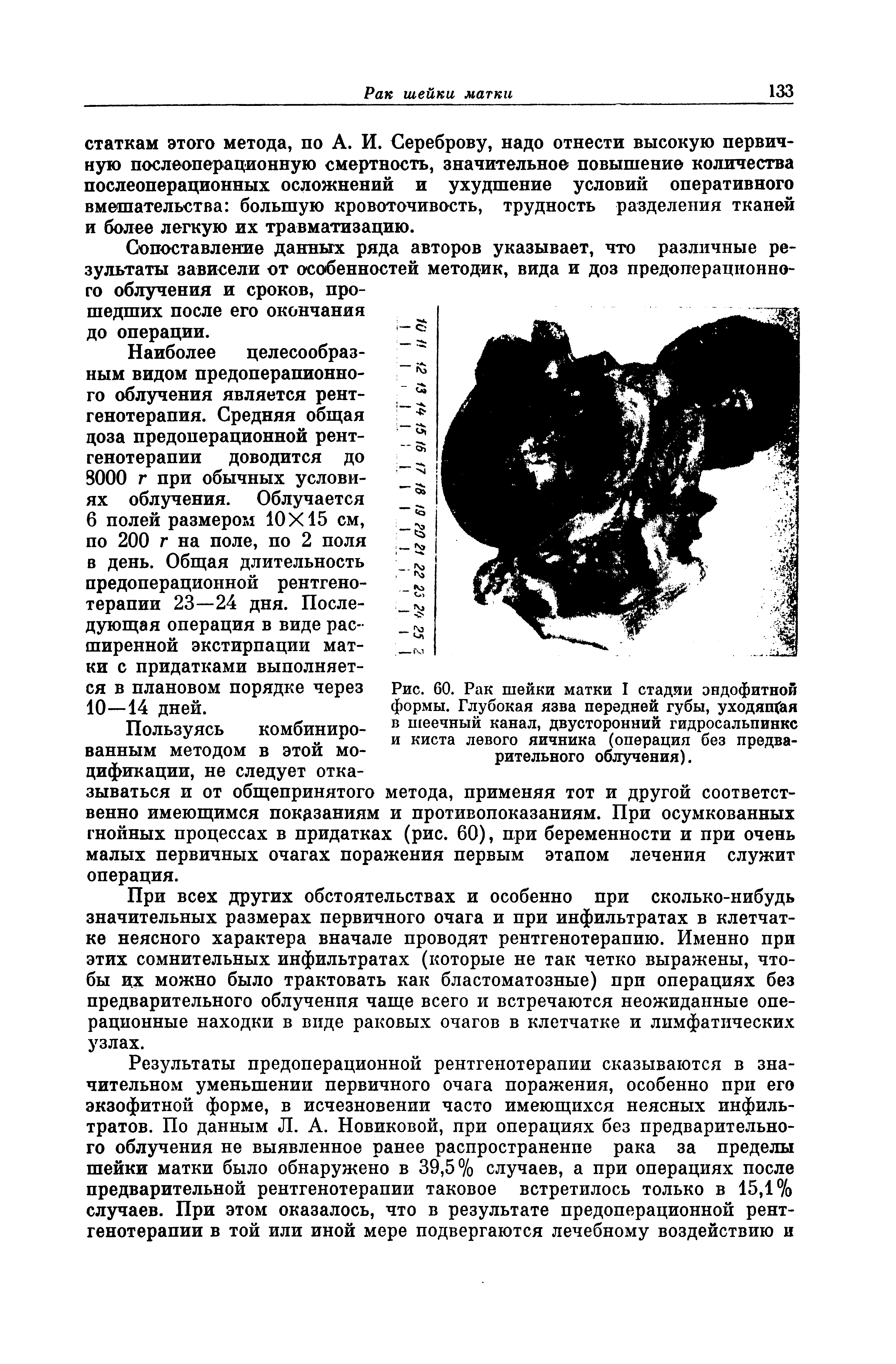 Рис. 60. Рак шейки матки формы. Глубокая язва передней губы, уходящая в шеечный канал, двусторонний гидросальпинкс и киста левого яичника (операция без предварительного облучения).