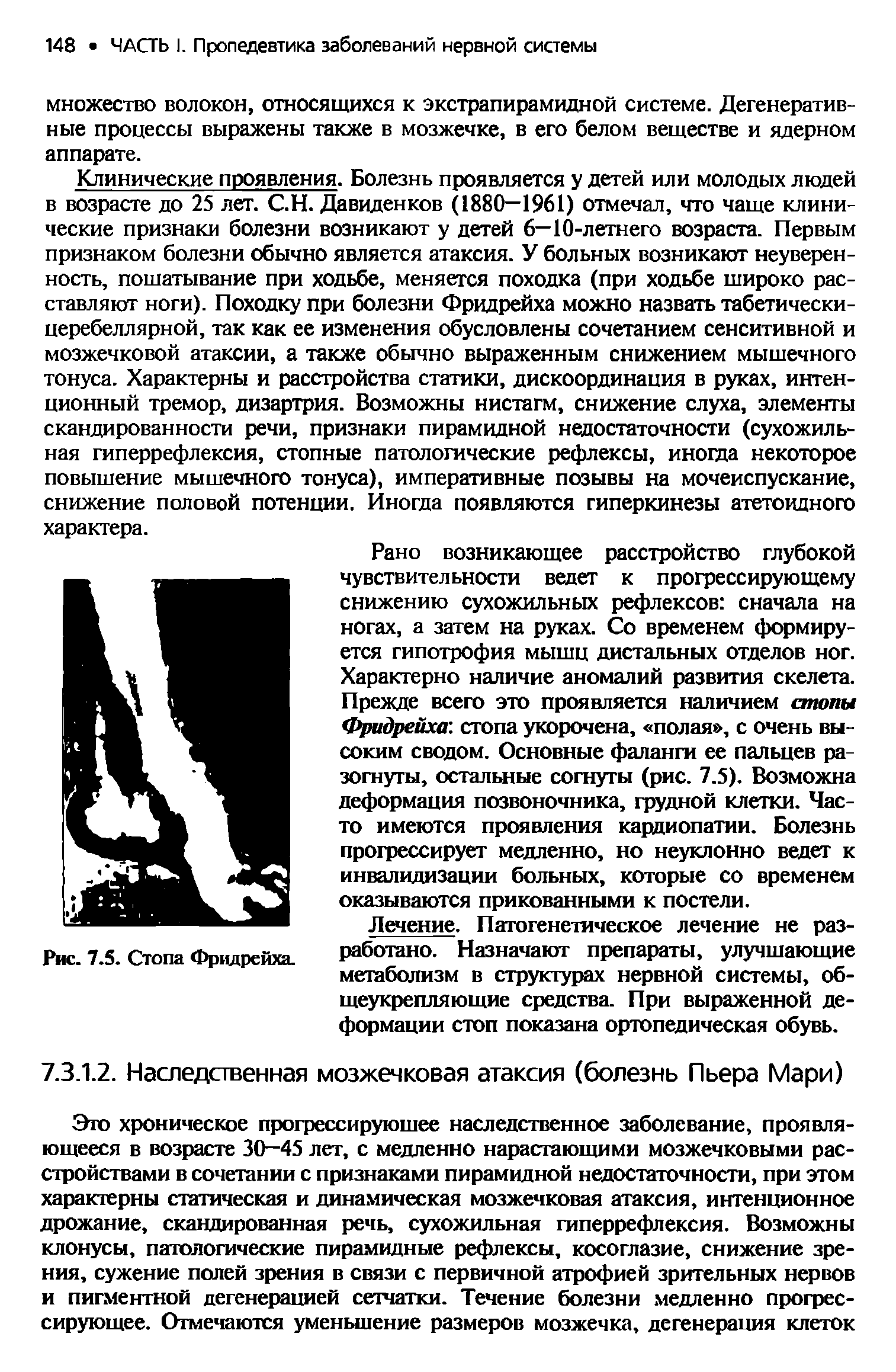 Рис. 7.5. Стопа Фридрейха. работано. Назначают препараты, улучшающие метаболизм в структурах нервной системы, общеукрепляющие средства. При выраженной деформации стоп показана ортопедическая обувь.