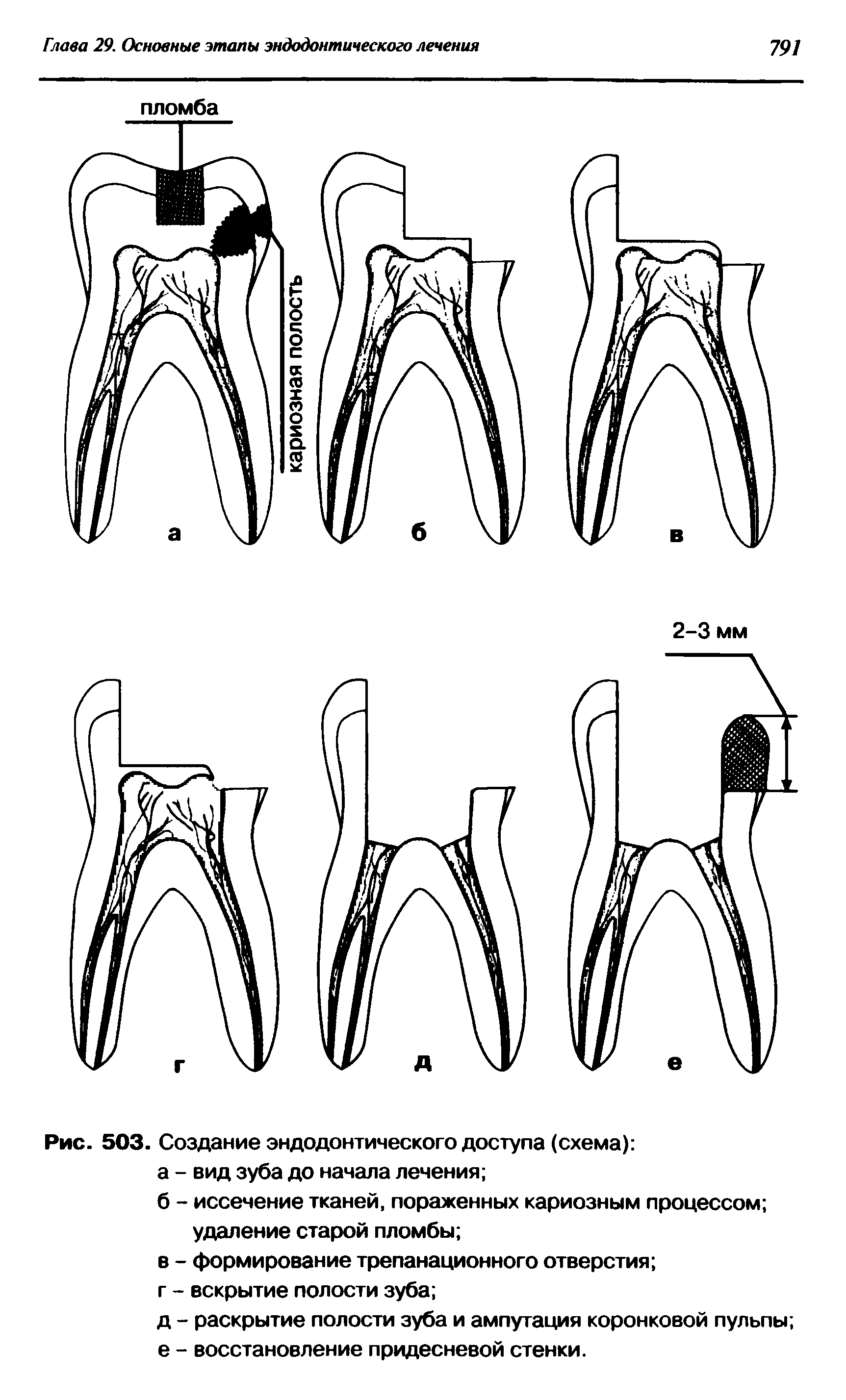 Рис. 503. Создание эндодонтического доступа (схема) а - вид зуба до начала лечения ...