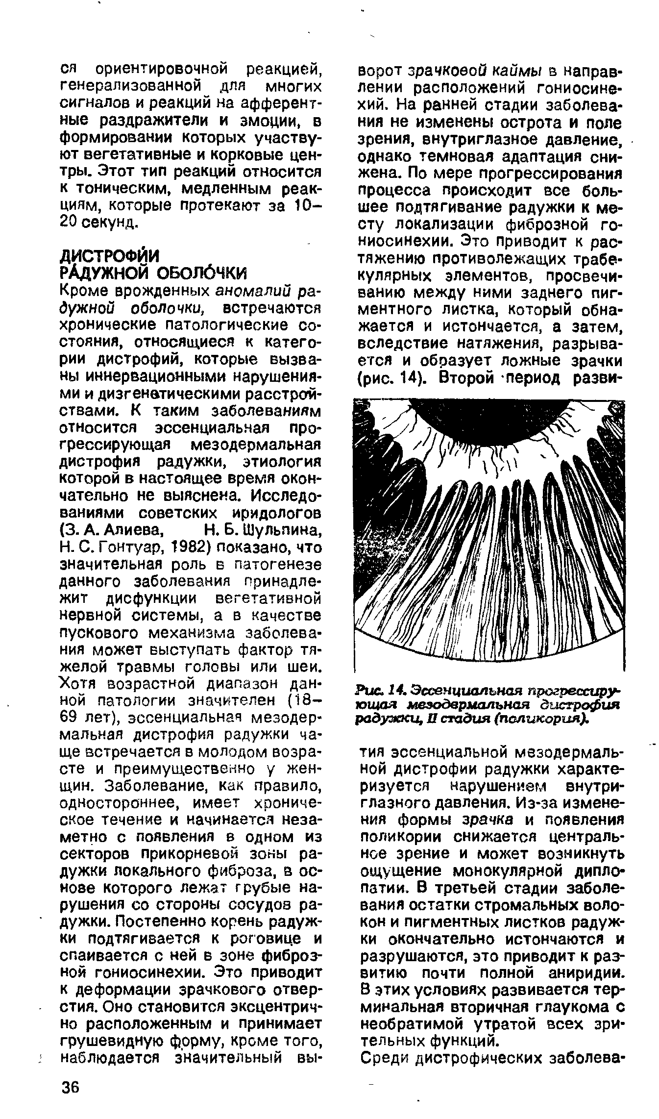 Рис. 14. Эссенциальная прогрессирующая мезодермальная дистрофия радужки, П стадия (поликория).