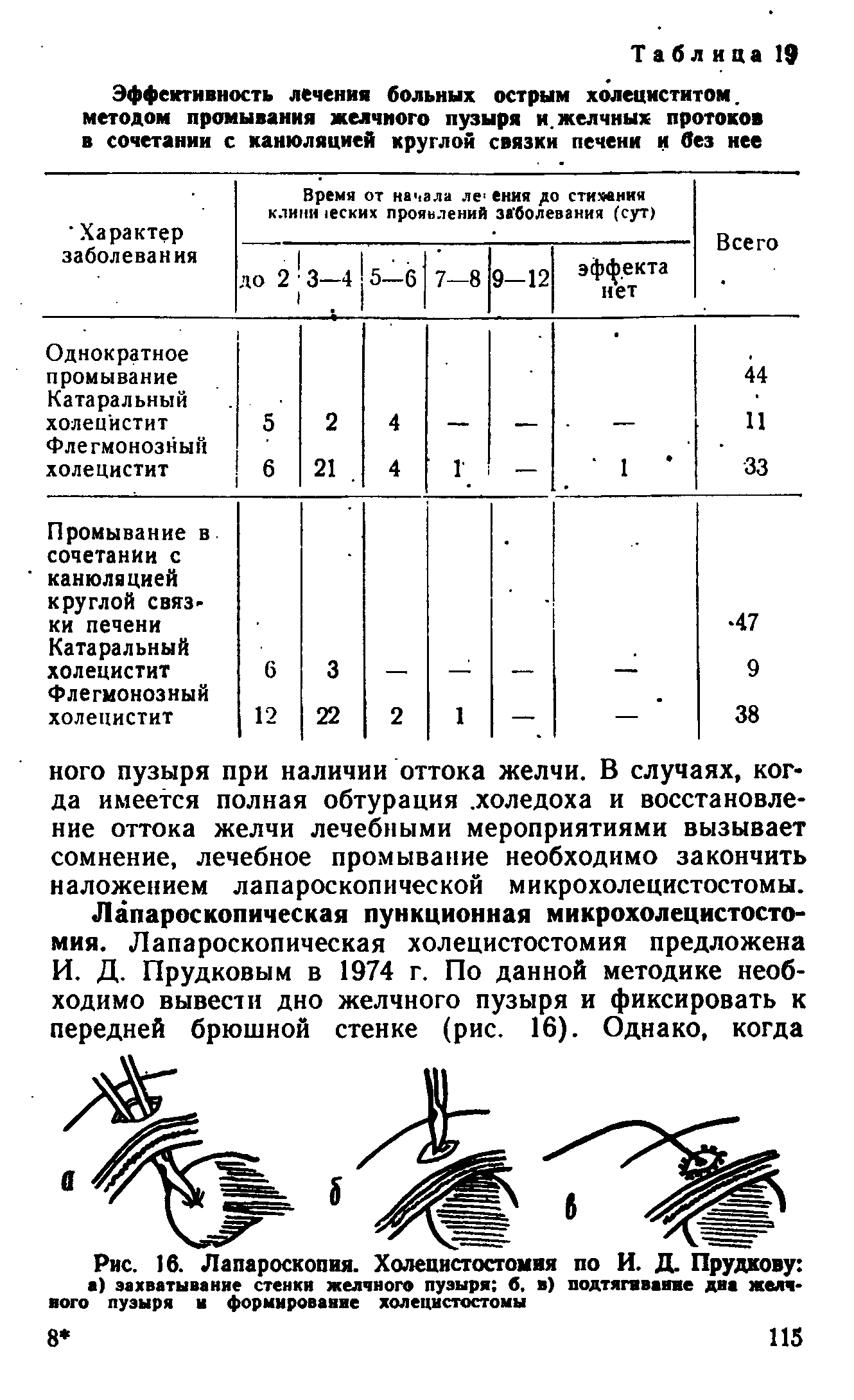 Рис. 16. Лапароскопия. Холецистостомия по И. Д. Прудкову а) захватывание стенки желчного пузыри б. в) подтягивание дна желчного пузыря и формирование холецистостомы...