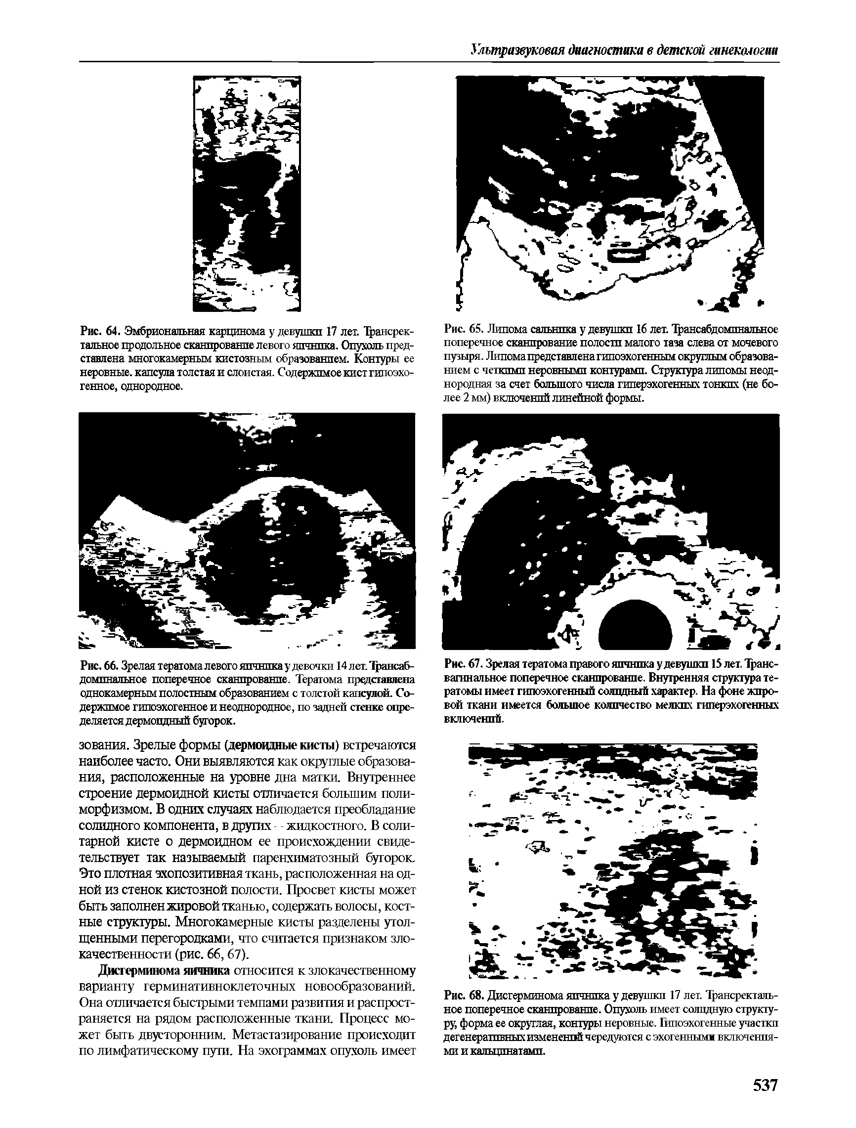 Рис. 66. Зрелая тератома левого яичника у девочки 14 летЛрансаб-домпнальное поперечное сканирование. Тератома представлена однокамерным полостным образованием с толстой капсулой. Содержимое гипоэхогенное и неоднородное, по задней стенке определяется дермоидный бугорок.