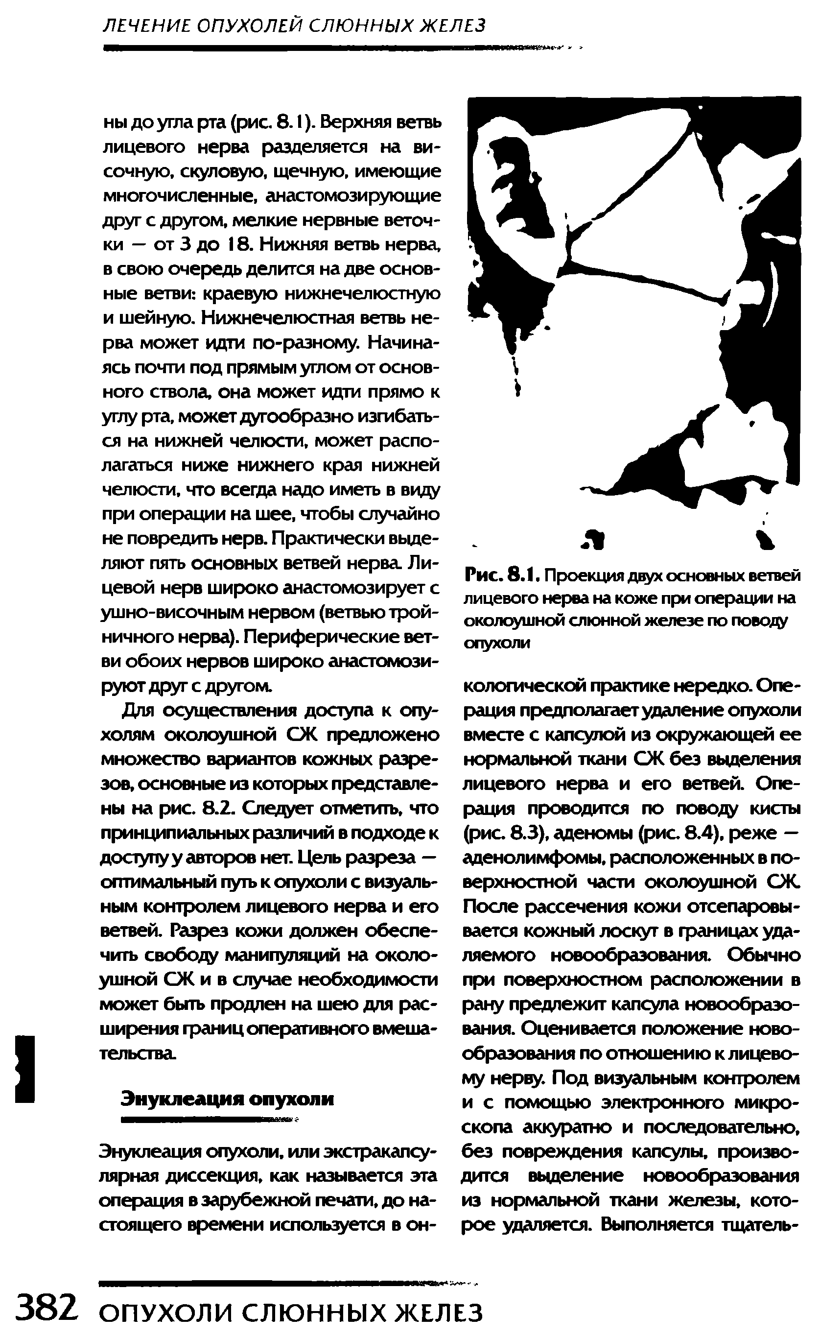 Рис. 8.1. Проекция двух основных ветвей лицевого нерва на коже при операции на околоушной слюнной железе по поводу опухоли...