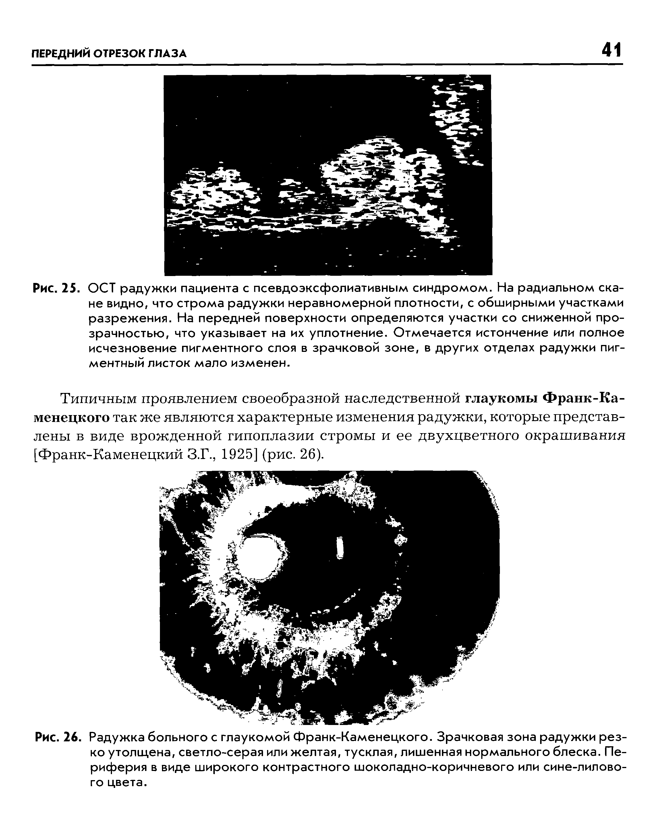 Рис. 26. Радужка больного с глаукомой Франк-Каменецкого. Зрачковая зона радужки резко утолщена, светло-серая или желтая, тусклая, лишенная нормального блеска. Периферия в виде широкого контрастного шоколадно-коричневого или сине-лилового цвета.