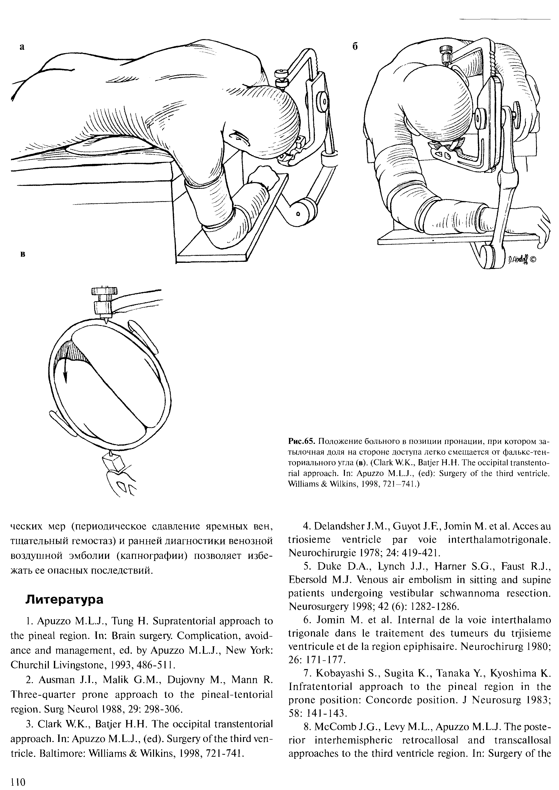 Рис.65. Положение больного в позиции пронации, при котором затылочная доля на стороне доступа легко смещается от фалькс-тен-ториального угла (в). (C W.K., B Н.Н. T . I A ( ) S .