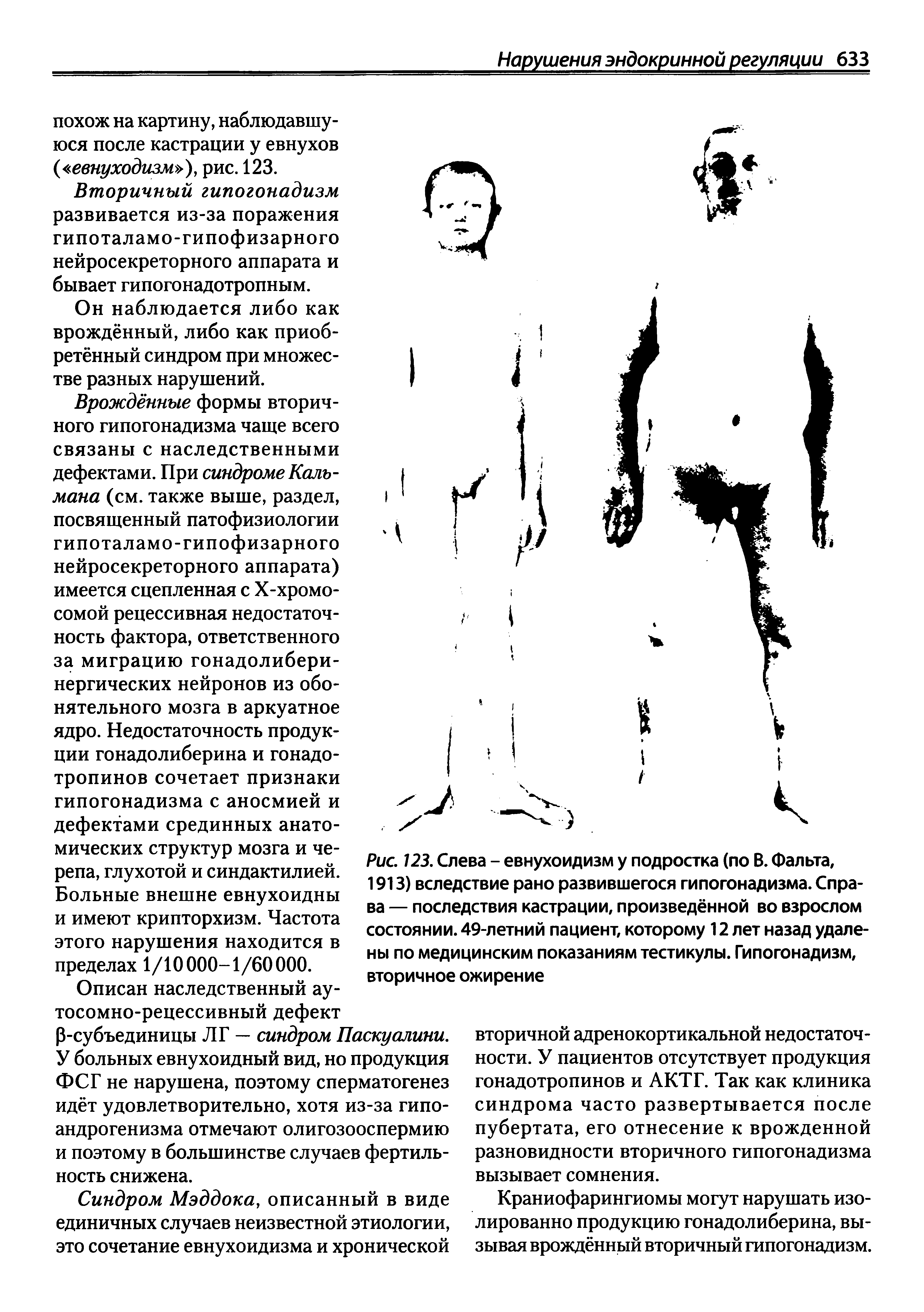 Рис. 123. Слева - евнухоидизм у подростка (по В. Фальта, 1913) вследствие рано развившегося гипогонадизма. Справа — последствия кастрации, произведённой во взрослом состоянии. 49-летний пациент, которому 12 лет назад удалены по медицинским показаниям тестикулы. Гипогонадизм, вторичное ожирение...