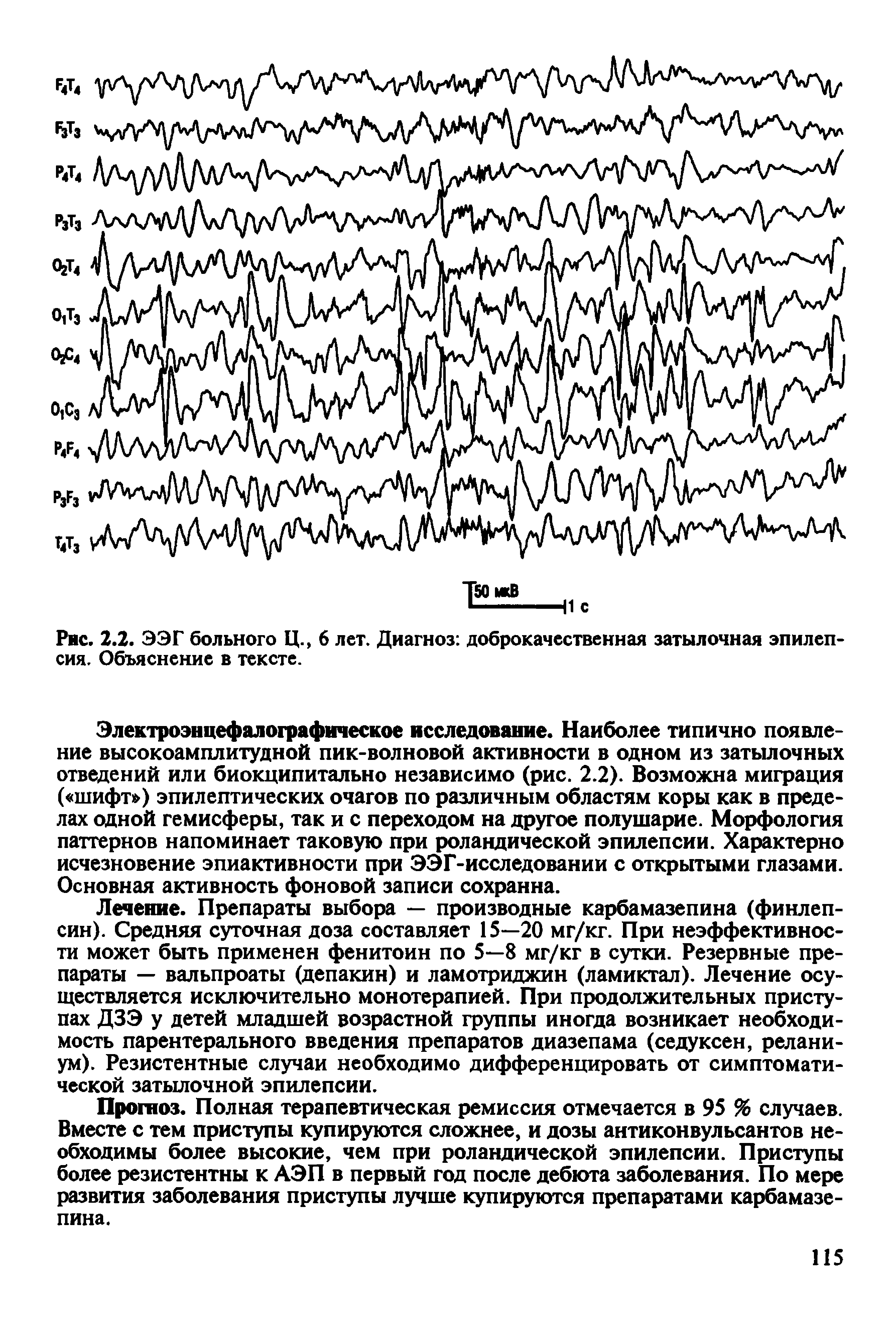 Рис. 2.2. ЭЭГ больного Ц., 6 лет. Диагноз доброкачественная затылочная эпилепсия. Объяснение в тексте.