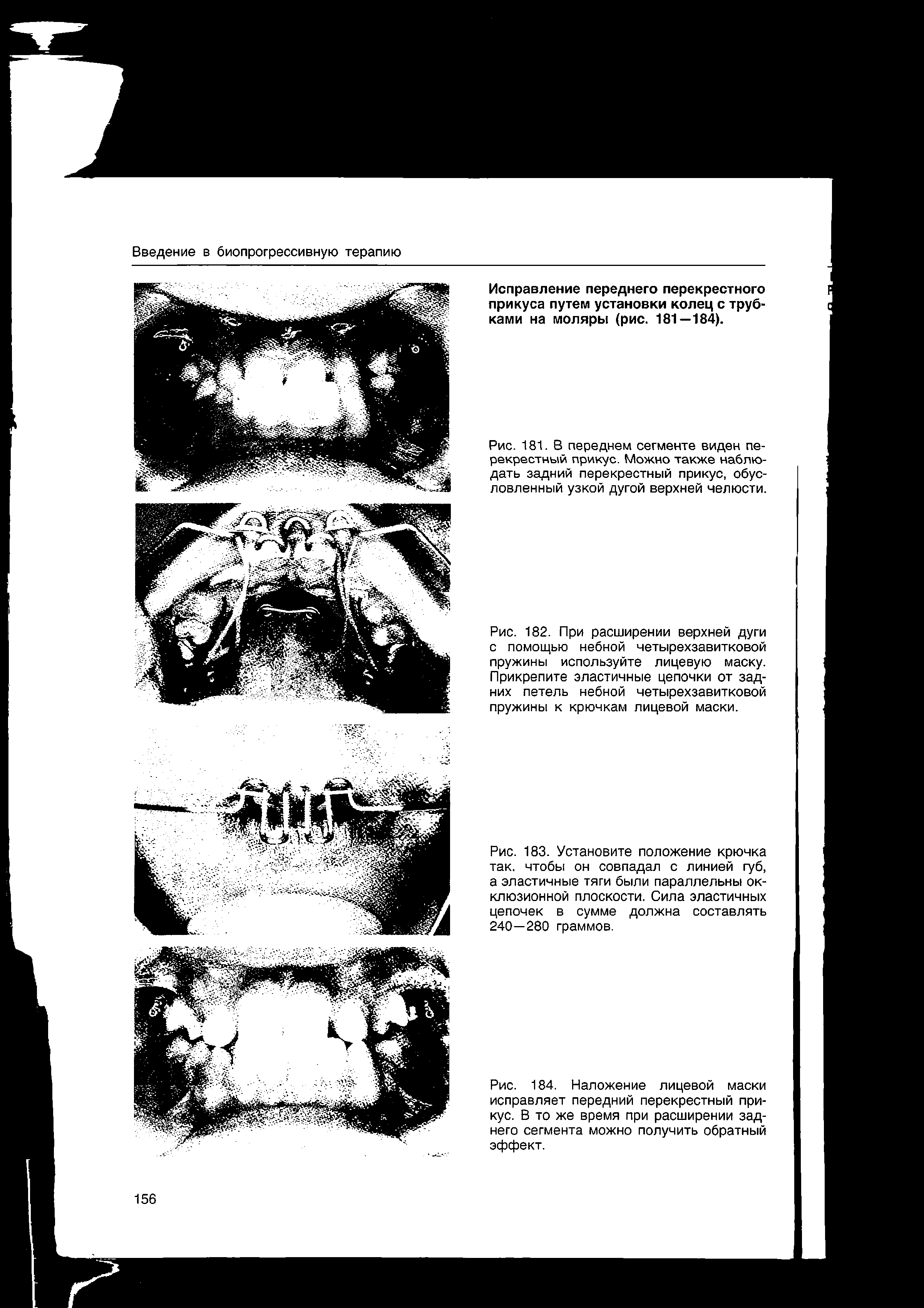 Рис. 182. При расширении верхней дуги с помощью небной четырехзавитковой пружины используйте лицевую маску. Прикрепите эластичные цепочки от задних петель небной четырехзавитковой пружины к крючкам лицевой маски.