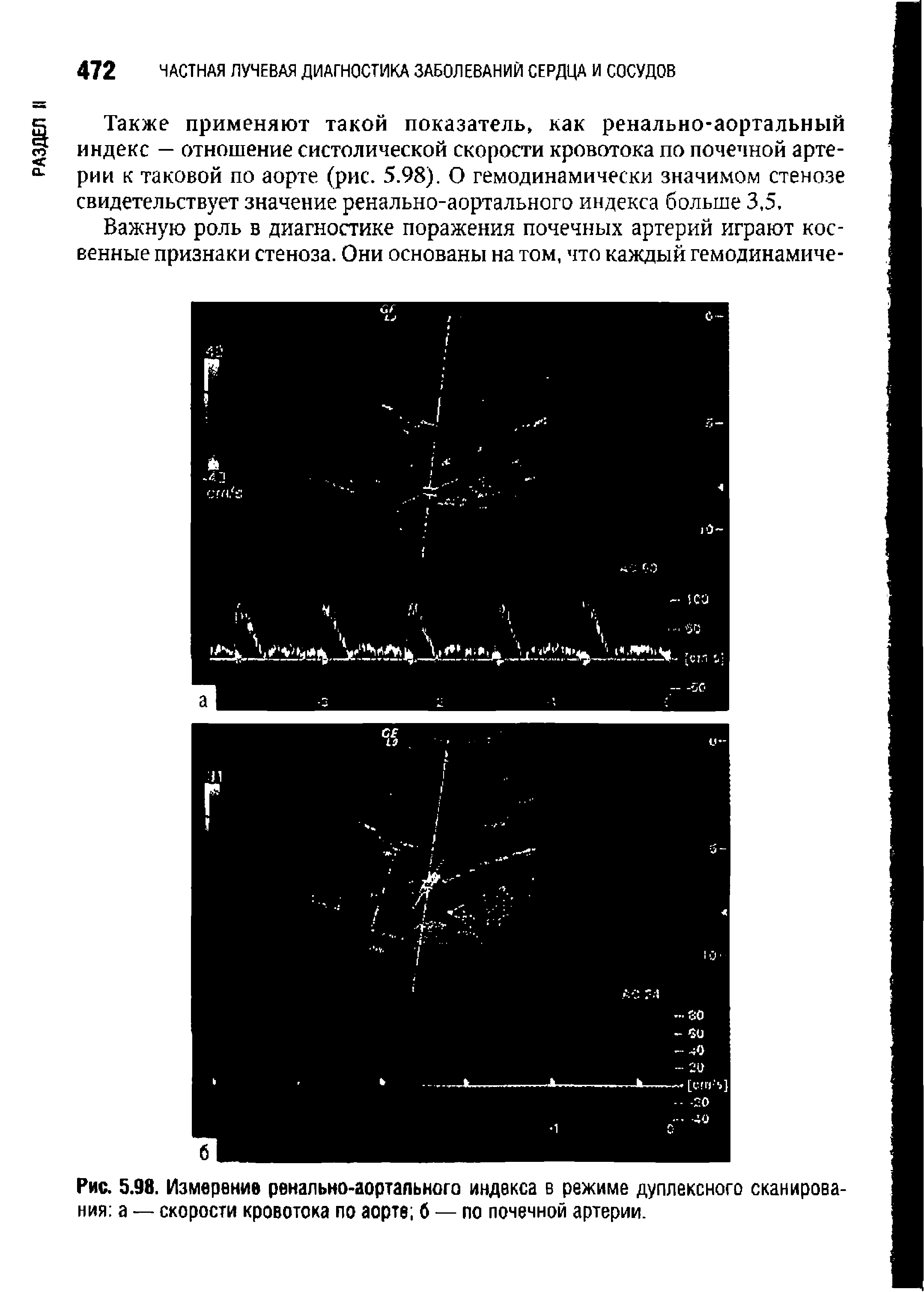 Рис. 5.98. Измерение ренально-аортального индекса в режиме дуплексного сканированиям — скорости кровотока по аорте б — по почечной артерии.