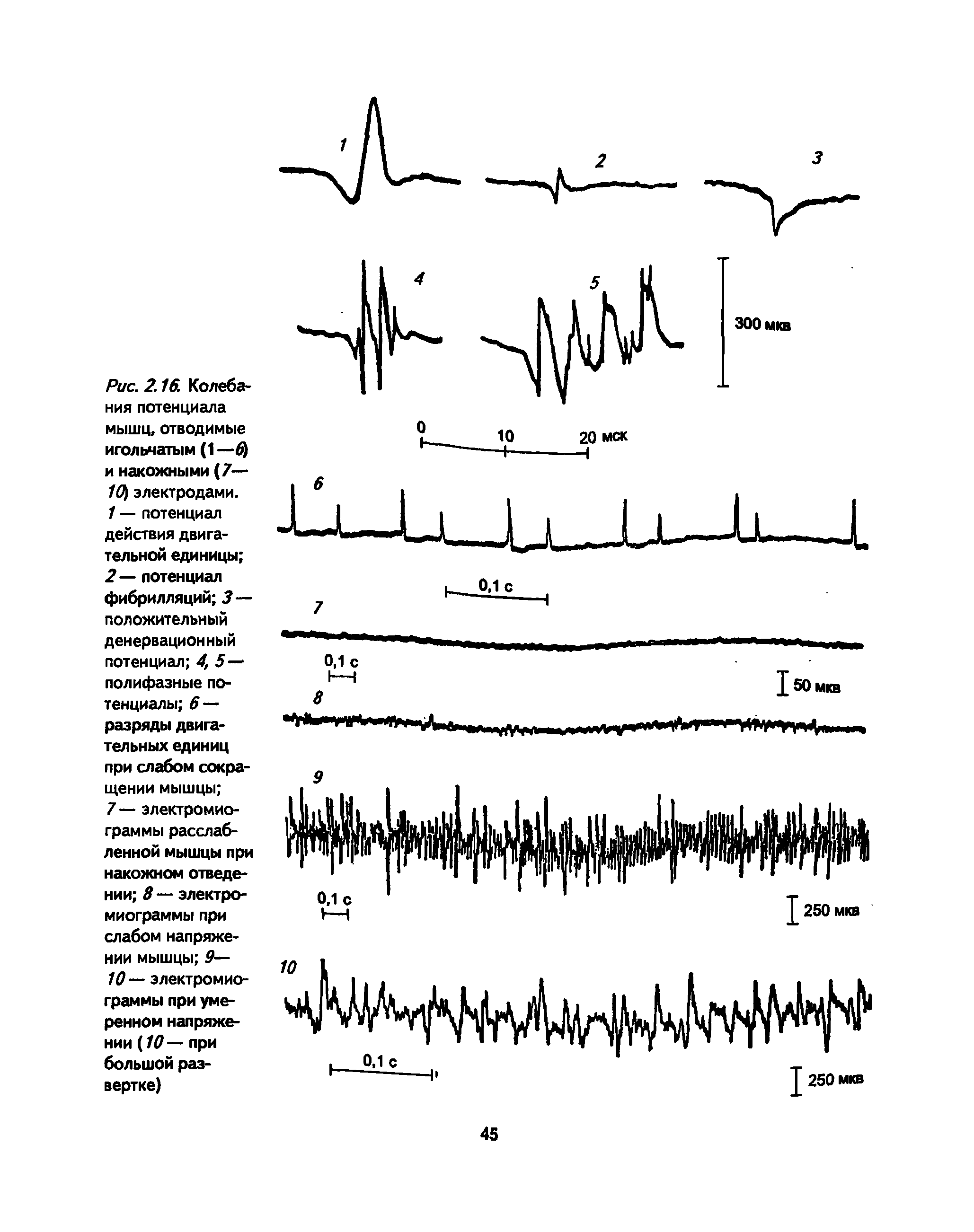 Рис. 2.16 Колебания потенциала мышц, отводимые игольчатым (1 —ф и накожными (7— /0 электродами. 1 — потенциал действия двигательной единицы 2— потенциал фибрилляций 3— положительный денервационный потенциал 4, 5— полифазные потенциалы 6 — разряды двигательных единиц при слабом сокращении мышцы ...