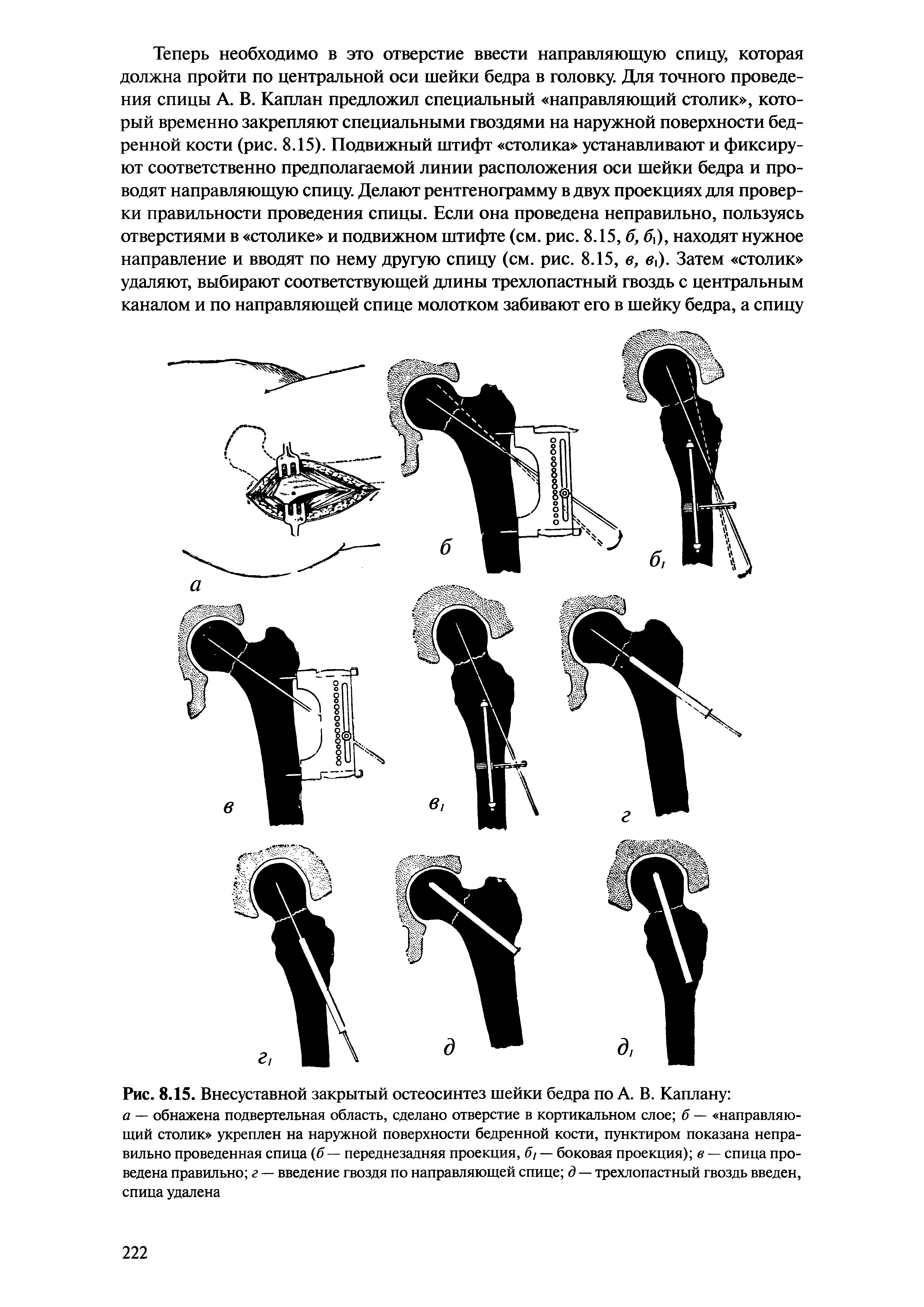 Рис. 8.15. Внесуставной закрытый остеосинтез шейки бедра по А. В. Каплану ...