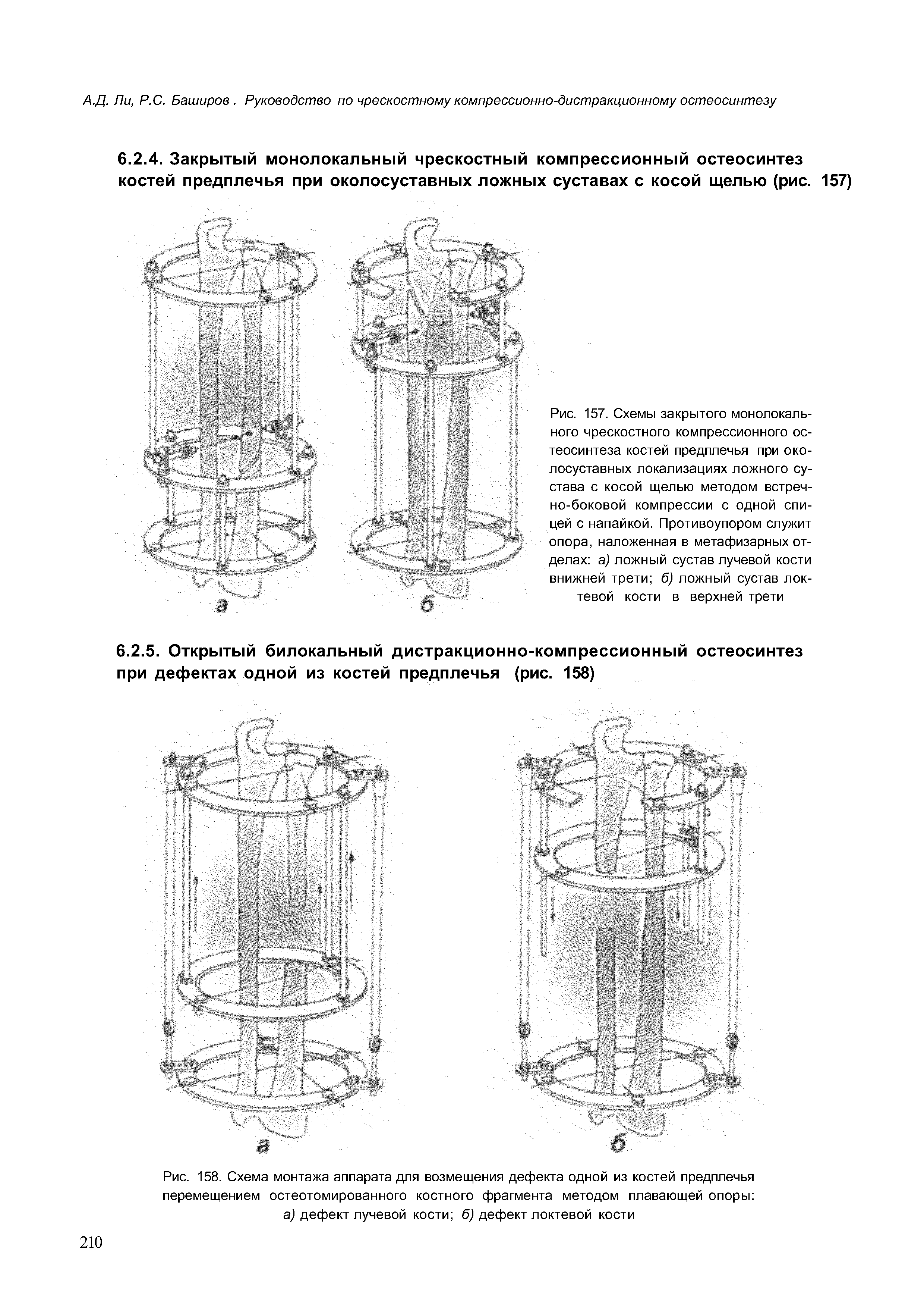 Рис. 158. Схема монтажа аппарата для возмещения дефекта одной из костей предплечья перемещением остеотомированного костного фрагмента методом плавающей опоры а) дефект лучевой кости б) дефект локтевой кости...