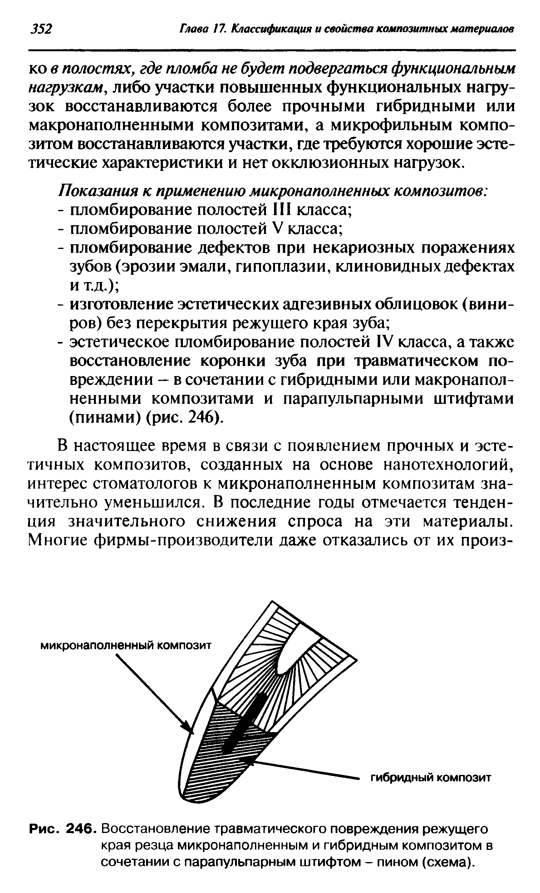 Рис. 246. Восстановление травматического повреждения режущего края резца микронаполненным и гибридным композитом в сочетании с парапульпарным штифтом - пином (схема).