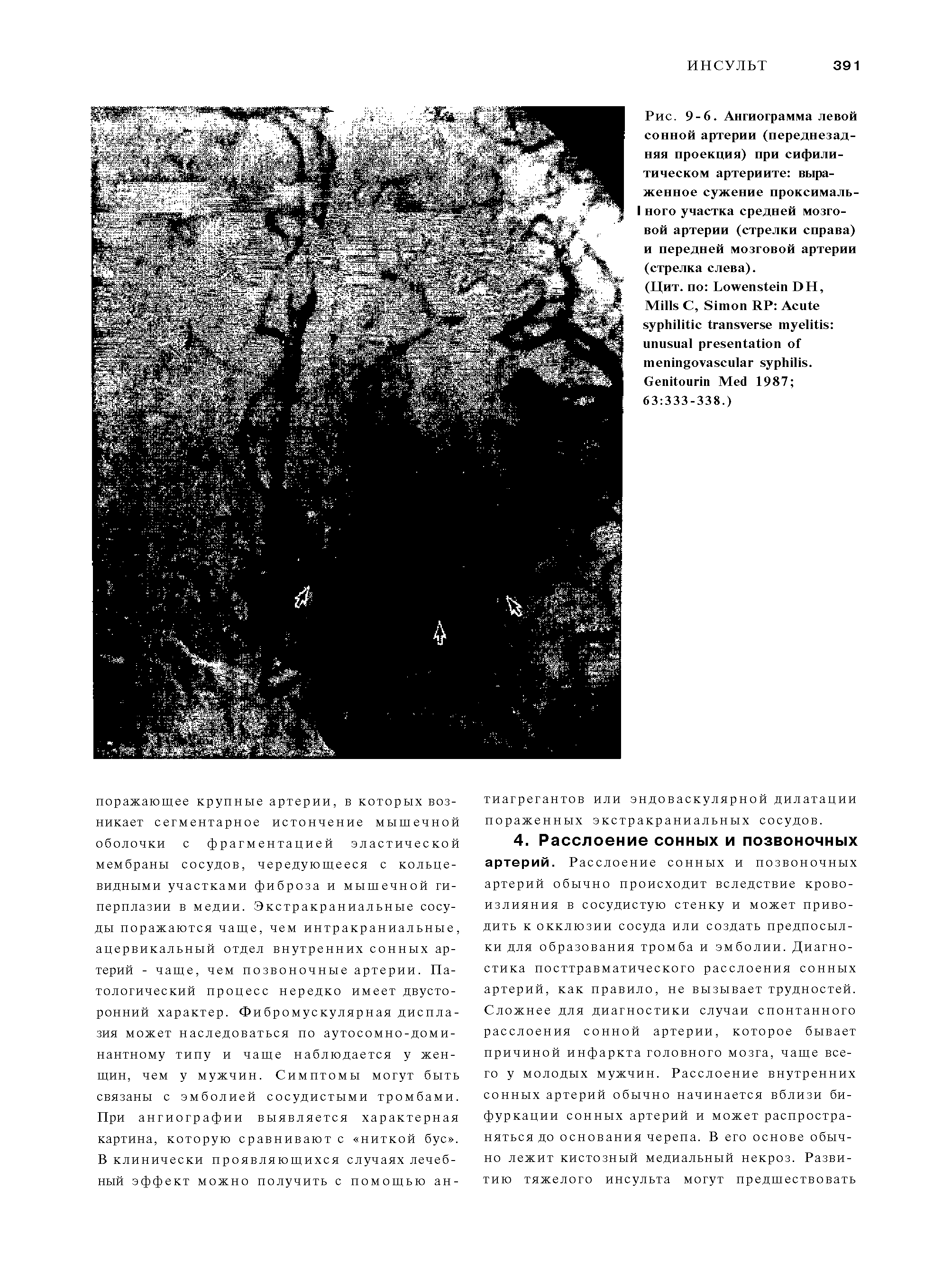 Рис. 9-6. Ангиограмма левой сонной артерии (переднезадняя проекция) при сифилитическом артериите выраженное сужение проксималь-I ного участка средней мозговой артерии (стрелки справа) и передней мозговой артерии (стрелка слева).