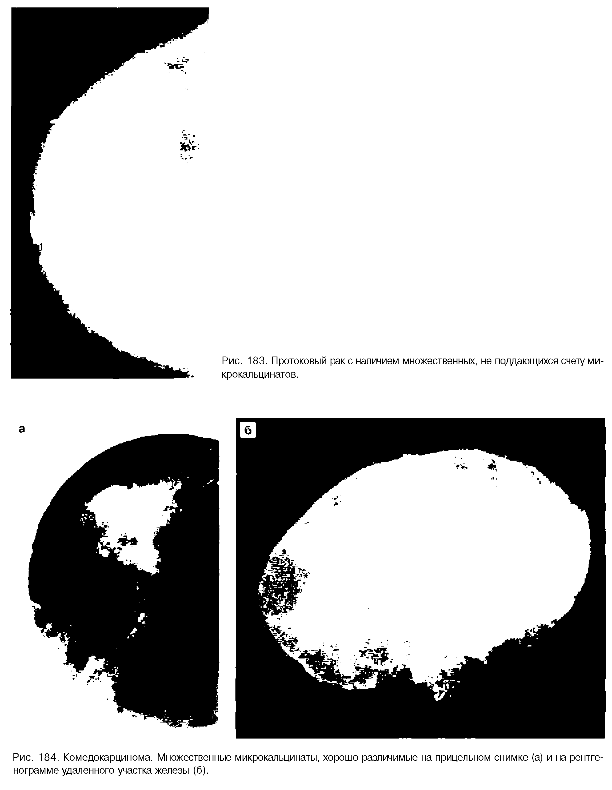 Рис. 184. Комедокарцинома. Множественные микрокальцинаты, хорошо различимые на прицельном снимке (а) и на рентгенограмме удаленного участка железы (б).