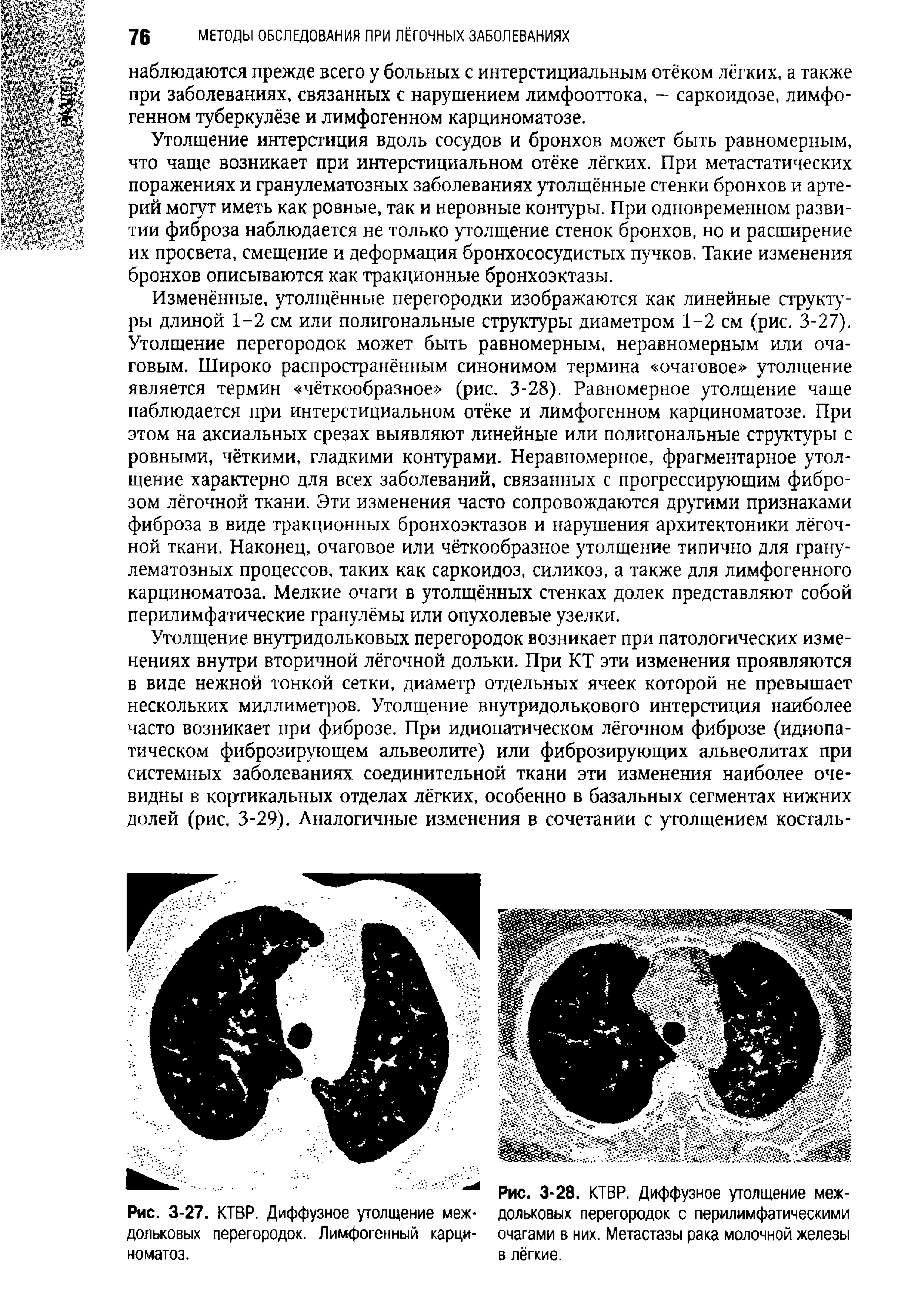 Рис. 3-28. КТВР. Диффузное утолщение междольковых перегородок с перилимфатическими очагами в них. Метастазы рака молочной железы в лёгкие.