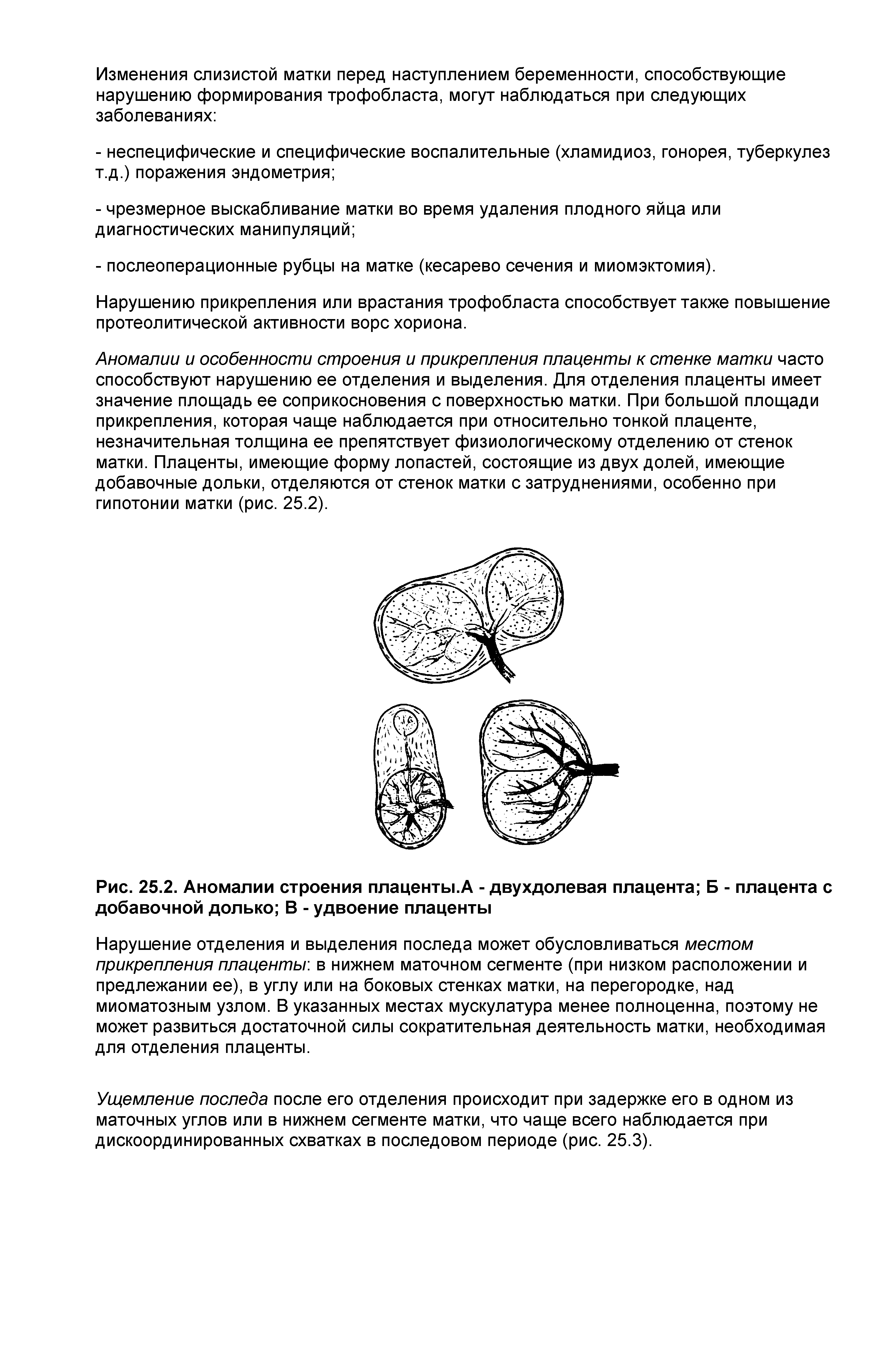 Рис. 25.2. Аномалии строения плаценты.А - двухдолевая плацента Б - плацента с добавочной долько В - удвоение плаценты...