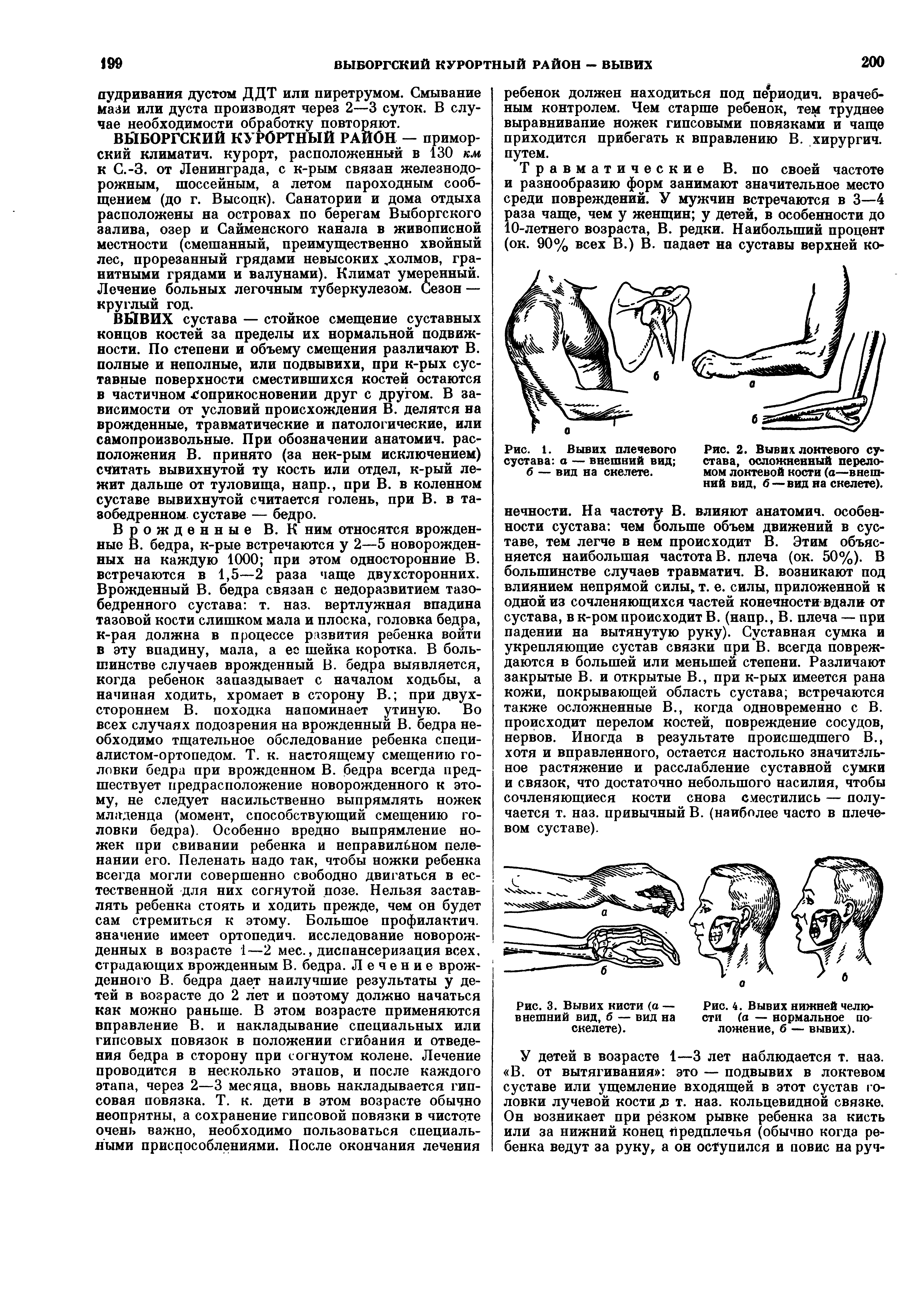 Рис. 2. Вывих локтевого сустава, осложненный переломом локтевой кости (а—внешний вид, б — вид на скелете).