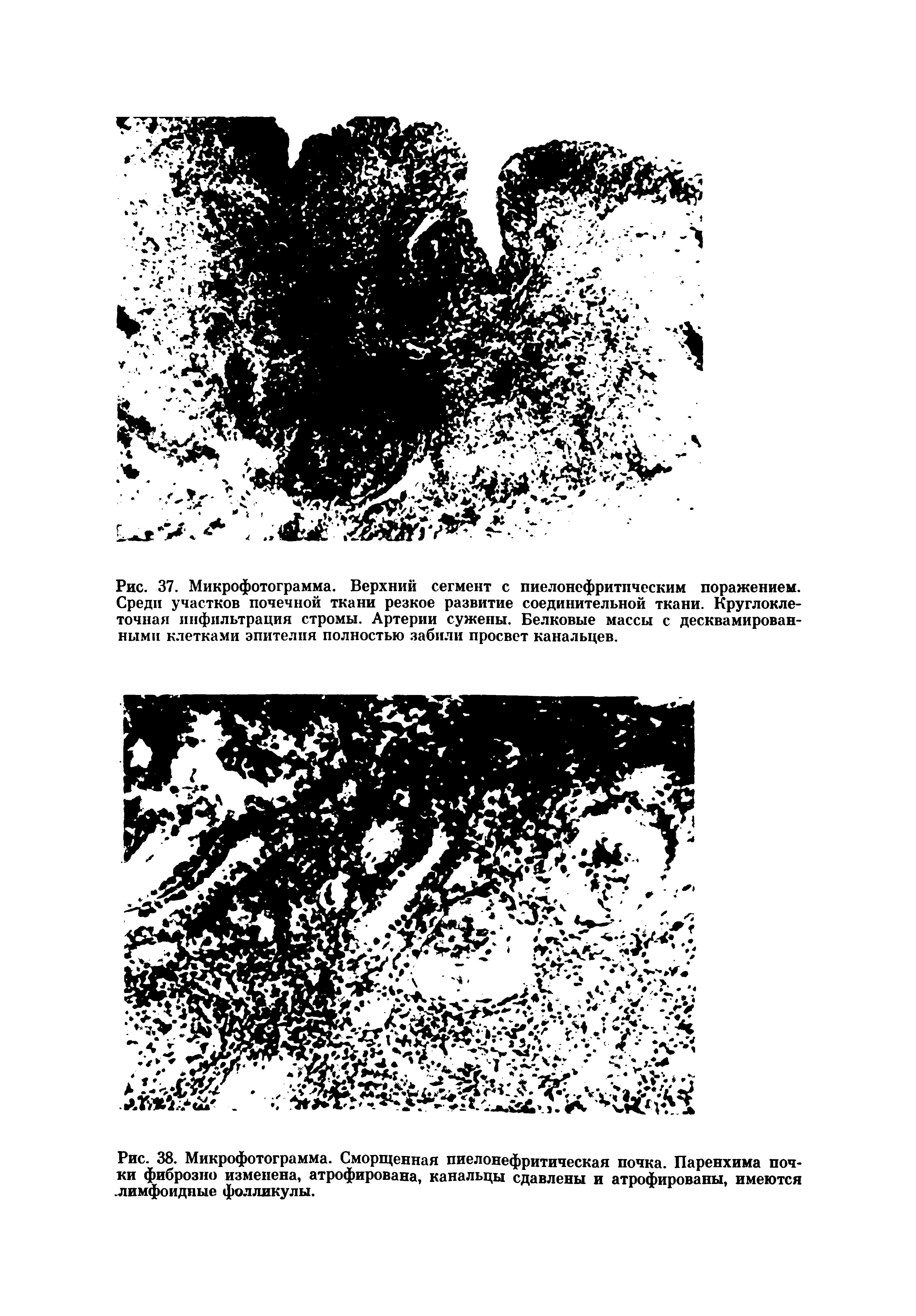 Рис. 38. Микрофотограмма. Сморщенная пиелонефритическая почка. Паренхима почки фиброзно изменена, атрофирована, канальцы сдавлены и атрофированы, имеются лимфоидные фолликулы.