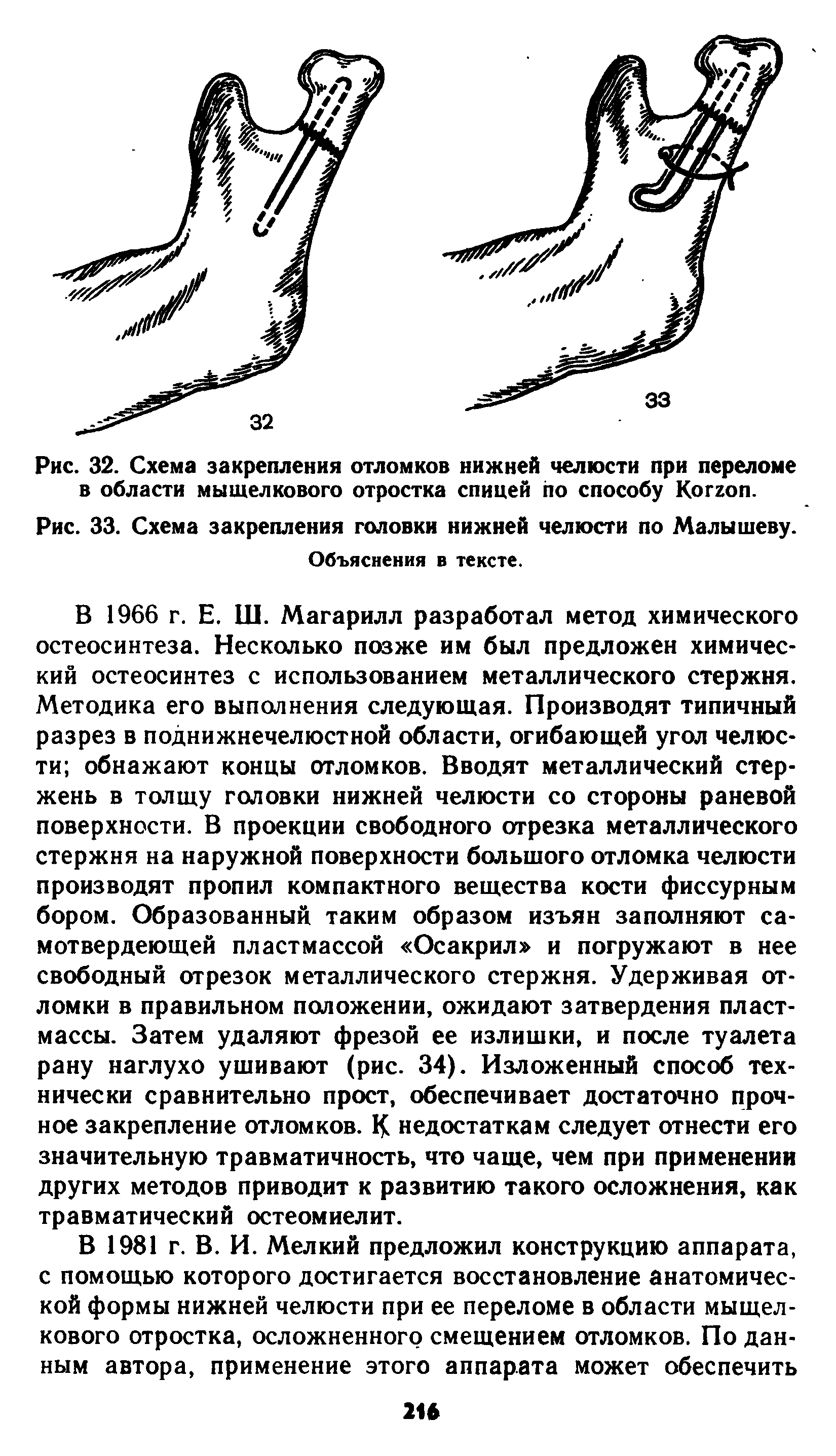 Рис. 33. Схема закрепления головки нижней челюсти по Малышеву.