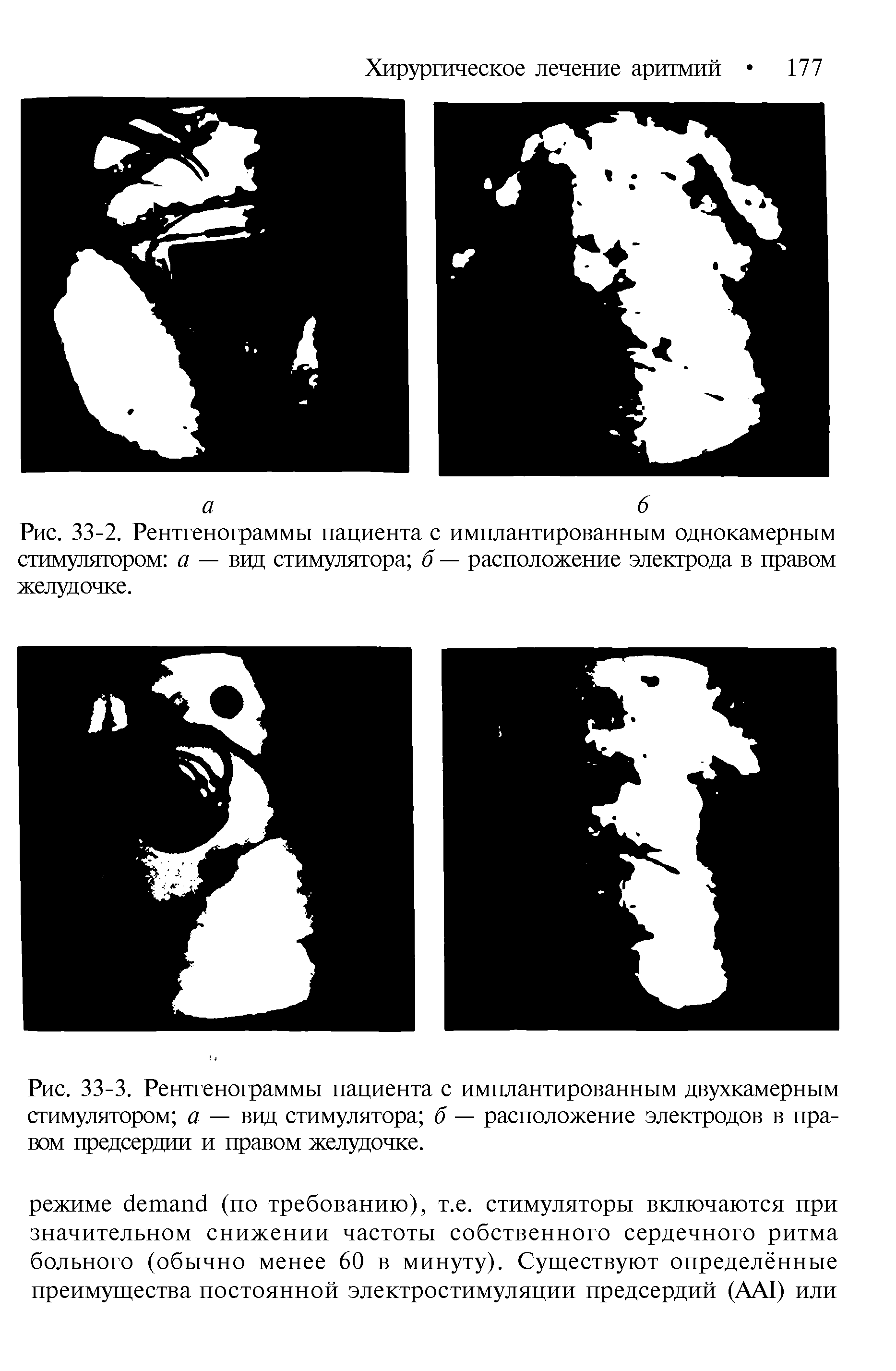 Рис. 33-3. Рентгенограммы пациента с имплантированным двухкамерным стимулятором а — вид стимулятора б — расположение электродов в правом предсердии и правом желудочке.